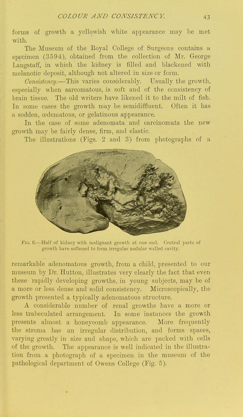 COLOUR AND CONSISTENCY. forms of growth a yellowish white appearance may be met with. The Museum of the Eoyal College of Surgeons contains a specimen (3594), obtained from the collection of Mr. George Laugstaff, in which the kidney is filled and blackened with melanotic deposit, although not altered in size or form. Consistency.—This varies considerably. Usually the growth, especially when sarcomatous, is soft and of the consistency of brain tissue. The old writers have likened it to the milt of fish. In some cases the growth may be semidiffluent. Often it has a sodden, oedematons, or gelatinous appearance. In the case of some adenomata and carcinomata the new growth may be fairly dense, firm, and elastic. The illustrations (Figs. 2 and 3) from photographs of a Fig. 6.—Half of kidney with malignant growth at one end. C'entr.al parts of growth have softened to form irregular nodular walled cavity. remarkable adenomatous growth, from a child, presented to our museum by Dr. Hutton, illustrates very clearly the fact that even these rapidly developing growths, in young subjects, may be of a more or less dense and solid consistency. Microscopically, the growth presented a typically adenomatous structure. A considerable number of renal growths have a more or less trabeculated arrangement. In some instances the growth presents almost a honeycomb appearance. More frequently the stroma has an irregular distribution, and forms spaces, varying greatly in size and shape, which are packed with cells of the growth. The appearance is well indicated in the illustra- tion from a photograph of a specimen in the museum of the pathological department of Owens College (Fig. 5).