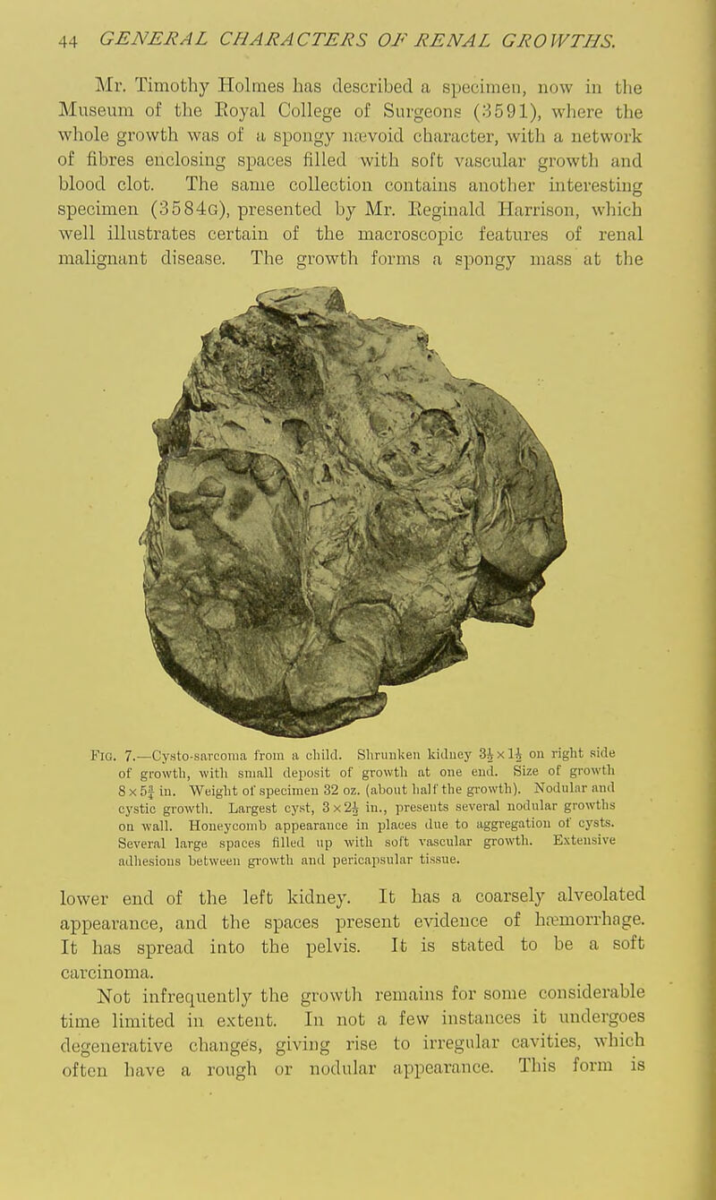 Mr. Timothy Holmes has described a specimen, now in the Museum of the Eoyal College of Surgeons (3591), where the whole growth was of a spongy najvoid character, with a network of fibres enclosing spaces filled with soft vascular growth and blood clot. The same collection contains another interesting specimen (3584g), presented by Mr. Eeginald Harrison, which well illustrates certain of the macroscopic features of renal malignant disease. The growth forms a spongy mass at the Fig. 7.—Cysto-sarcoma from a child. Shrunken kiduej' 3ixli on right side of growth, with small deposit of growth at one end. Size of growth 8 X 5f iu. Weight of specimen 32 oz. (about half the growth). NoduLir and cystic growth. Largest cy.st, 3x2^ in., presents several nodular growths on wall. Honeycomb appearance in places due to aggregation of cysts. Several large spaces filled up with soft vascular growth. Extensive adhesions between gi'owth and perioapsuhir tissue. lower end of the left kidney. It has a coarsely alveolated appearance, and the spaces present evidence of haemorrhage. It has spread into the pelvis. It is stated to be a soft carcinoma. Not infrequently the growili remains for some considerable time limited in extent. In not a few instances it undergoes degenerative changes, giving rise to irregular cavities, which often have a rough or nodular appearance. This form is