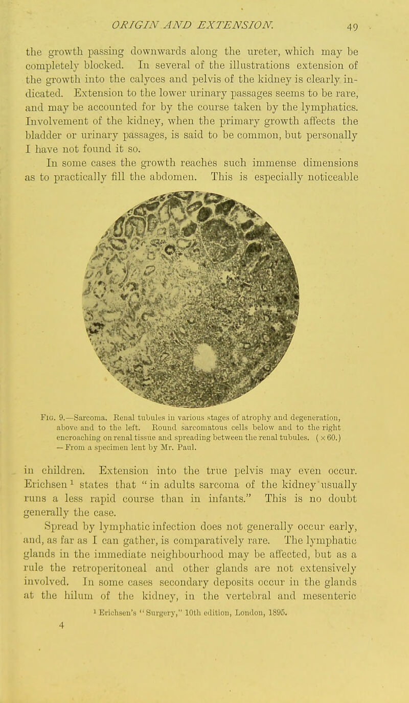 ORIGIN AND EXTENSION. the growth passing downwards along the ureter, which may be completely blocked. In several of the illustrations extension of the growth into the calyces and pelvis of the kidney is clearly in- dicated. Extension to the lower urinary passages seems to be rare, and may be accounted for by the course taken by the lymphatics. Involvement of the kidney, when the primary growth affects the bladder or urinary passages, is said to be common, but personally I have not found it so. In some cases the growth reaches such immense dimensions as to practically fill the abdomen. This is especially noticeable Fig. 9.—Sarcoma. Reual tubules iu various stages of atrophy and degeneration, above and to tbe left. Bound sarcomatous cells below and to the right encroaching on renal tissue and spreading between the renal tubules. ( x 60.) — From a specimen lent by Mr. Paul. in children. Extension into the true pelvis may even occur. Erichsen^ states that in adults sarcoma of the kidney'usually runs a less rapid course than in infants. This is no doubt generally the case. Spread by lymphatic infection does not generally occur early, and, as far as I can gather, is comparatively rare. The lymphatic glands in the immediate neighbourhood may be affected, but as a rule the retroperitoneal and other glands are not extensively involved. In some cases secondary deposits occur in the glands at the hilum of the kidney, in the vertebral and mesenteric 1 Erichsen's Surgery, 10th edition, London, 1895. 4