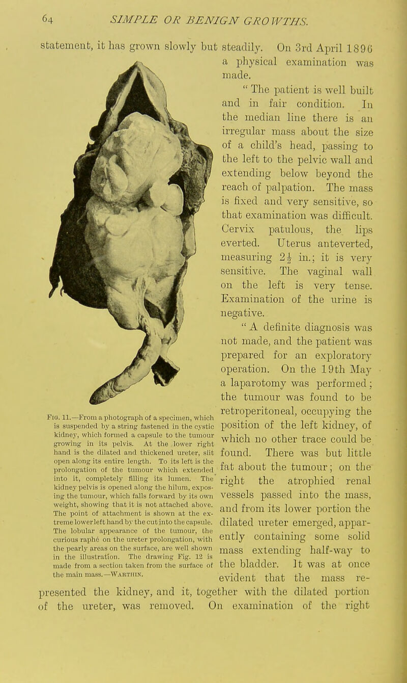 statement, it has grown slowly but steadily. On 3rd April 1896 a physical examination was made.  The patient is well built and in fair condition. In the median line there is an irregular mass about the size of a child's head, passing to the left to the pelvic wall and extending below beyond the reach of palpation. The mass is fixed and very sensitive, so that examination was difficult. Cervix patulous, the lips everted. Uterus anteverted, measuring 2^ in.; it is very sensitive. The vaginal wall on the left is very tense. Examination of the urine is negative.  A definite diagnosis was not made, and the patient was prepared for an exploratory operation. On the 19 th May a laparotomy was performed ; the tumour was found to be retroperitoneal, occupying the position of the left kidney, of which no other trace could be found. There was but little fat about the tumour; on the right the atrophied renal vessels passed into the mass, and from its lower portion the dilated ureter emerged, appar- ently containmg some solid mass extending half-way to the bladder. It was at once evident that the mass re- presented the kidney, and it, together with the dilated portion of the ureter, was removed. On examination of the right Fio. 11.—From a pliotograph of a specimen, which is suspended hy a string' fastened in the cystic kidney, which formed a capsule to the tumour growing in its pelvis. At the lower right hand is the dilated and thickened ureter, sMt open along its entire length. To its left is the prolongation of the tumour which extended into it, completely filling its lumen. The kidney pelvis is opened along tlie hilum, exjios- ing the tumour, which falls forward by its own weight, showing that it is not attached above. The point of attaclnnent is shown at the ex- treme lower left hand by the cut into the capsule. The lobular appearance of the tumour, the curious raph6 on the ureter prolongation, with the pearly areas on the surface, are well shown in the illustration. The drawing Fig. 12 is made from a section taken from the surface of the miiin mass.—Wartiiin.