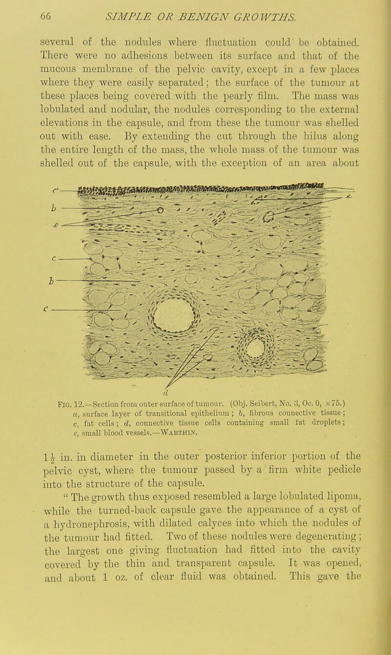 several of the nodules where lluctuation could be obtained. There were no adhesions between its surface and that of the mucous membrane of the pelvic cavity, except in a few places where they were easily separated; the surface of the tumour at these places being covered with the pearly film. The mass was lobulated and nodular, the nodules corresponding to the external elevations in the capsule, and from these tlie tumour was shelled out with ease. By exteuding the cut through the hilus along the entire length of the mass, the whole mass of the tumour was shelled out of the capsule, with the exception of an area about c d Fig. 12.—Section from outer surface of tumour. (Obj. Seibert, No. 3, Oc. 0, x 75.) ft, surface layer of transitional epithelium ; h, fibrous connective tissue; c, fat cells; d, connective tissue cells containing small i'at droplets; e, small blood vessels.—Warthin. 1 h in. in diameter in the outer posterior inferior portion of the pelvic cyst, where the tumour passed by a firm white pedicle into the structure of the capsule.  The growth thus exposed resembled a large lobulated lipoma, while the turned-back capsule gave the appearance of a cyst of a hydronephrosis, with dilated calyces into which the nodules of the tumour had fitted. Two of these nodules were degenerating ; the largest one giving fiuctuation had fitted into the cavity covered by the thin and transparent capsule. It was opened, and about 1 oz. of clear fluid was obtained. This gave the