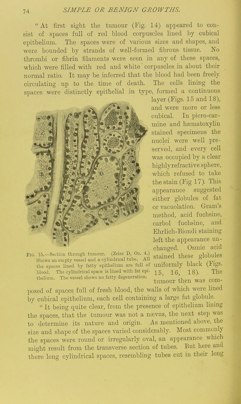 At first sight the tumour (Fig. 14) appeared to con- sist of spaces full of red blood corpuscles lined by cubical epithelium. The spaces were of various sizes and shapes, and were bounded by strands of well-formed fibrous tissue. No thrombi or fibrin filaments were seen in any of these spaces, which were filled with red and white' corpuscles in about their normal ratio. It may be inferred that the blood had been freely circulating up to the time of death. The cells lining the spaces were distinctly epithelial in type, formed a continuous layer (Figs. 15 and 18), and were more or less cubical. In picro-car- mine and haematoxylin stained specimens the nuclei were well pre- served, and every cell was occupied by a clear highlyrefractive sphere, wliich refused to take the stain (Fig 17). This appearance suggested either globules of fat or vacuolation. Gram's method, acid fuchsiue, carbol fuchsiue, and Ehrlich-Biondi staining left the appearance un- changed. Osmic acid FIG. 15.-Section tlirougli tumour. (Zeiss D Oc. 4 ) ^^^^^ globules Shows aB empty vessel and a oylmdrioal tube. All => the spaces lined by fatty epithelium are full of uniformly black (-tlgS- blood. The oylLndrioalspace is lined with fat epi- g ^6, 18). The thelium. The vessel shows no fatty degeneration. ' ' tumour then was com- posed of spaces full of fresh blood, the walls of which were Imed by cubical epithelium, each cell containing a large fat globule.^  It being quite clear, from the presence of epithehum Humg the spaces, that the tumour was not a ntevus, the next step was to determine its nature and origin. As mentioned above, the size and shape of the spaces varied considerably. Most commonly the spaces were round or irregularly oval, an appearance which might result from the transverse section of tubes. But here and there long cylindrical spaces, resembling tubes cut in their long