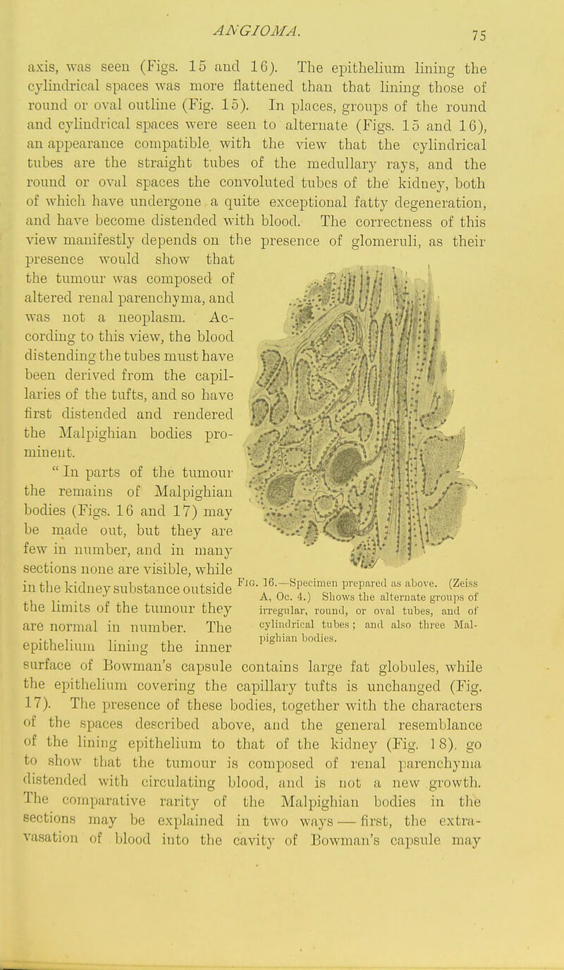 axis, was seeu (Figs. 15 and 16). The epithelium lining the cylindrical spaces was more flattened than that lining those of round or oval outline (Fig. 15). In places, groups of the round and cylindrical sj)aces were seeu to alternate (Figs. 15 and 16), an appearance compatible with the view that the cylindrical tubes are the straight tubes of the medullary rays, and the round or oval spaces the convoluted tubes of the kidney, both of which have undergone a quite exceptional fatty degeneration, and have become distended with blood. The correctness of this view manifestly depends on the presence of glomeruli, as their presence would show that the tumour was composed of altered renal parenchyma, and was not a neoplasm. Ac- corduig to this view, the blood distending the tubes must have been derived from the capil- laries of the tufts, and so have first distended and rendered the Malpighian bodies pro- minent.  In parts of the tumour the remains of Malpighian bodies (Figs. 16 and 17) may be niade out, but they are few in number, and in many sections none are visible, while r> :-\'. in the kidney substance outside f-'^^'fT prepared a. above. (Zeiss . . A, Oc. 4.) bliows the alternate groups of the limits of the tumour they irregular, rouml, or oval tubes, and of are normal in number. The cylindrical tubes ; aud also three Mal- • ,1 . , . pigliiau bodies. epitheiuiiu Imiiig the inner surface of Bowman's capsule contains large fat globules, while the epithelium covering the capillary tufts is unchanged (Fig. 17). The presence of these bodies, together with the characters of the spaces described above, and the general resemblance of the lining epithelium to that of the kidney (Fig. 18), go to show tliat the tumour is composed of renal parenchyma distended with circulating blood, and is not a new growth. The comparative rarity of the Malpighian bodies in the sections may be explained in two ways — first, the extra- vasation of blood into the cavity of Bowman's capsule may