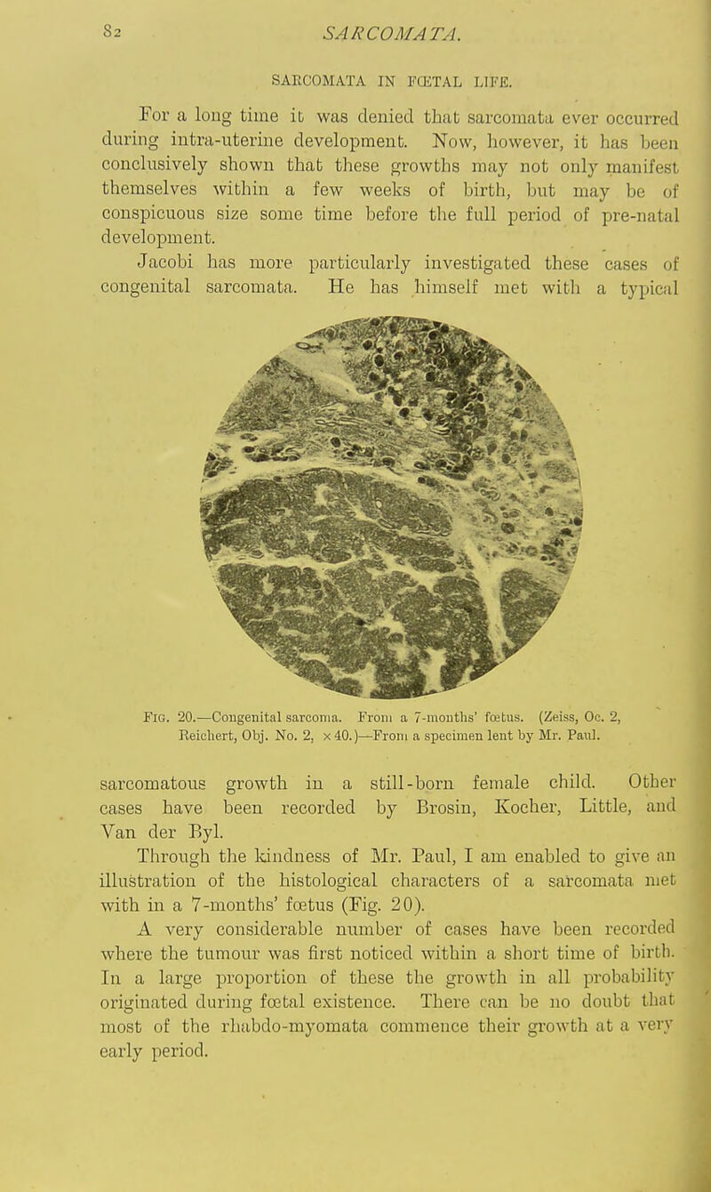 SARCOMATA IN FCETAL LIFE. For a loug time it was denied that sarcomata ever occurred during intra-uteriiie development. Now, however, it has been conclusively shown that these growths may not only manifest themselves within a few weeks of birth, but may be of conspicuous size some time before the full period of pre-natal development. Jacobi has more particularly investigated these cases of congenital sarcomata. He has himself met with a typical Fig. 20.—Congenital sarcoma. From a 7-mouths' foetus. (Zeiss, Oc. 2, Reicliert, Obj. No. 2, x40.)—From a specimen lent by Mr. Paul. sarcomatous growth in a still-born female child. Other cases have been recorded by Brosin, Kocher, Little, and Van der Byl. Through the Idndness of Mr. Paul, I am enabled to give an illustration of the histological characters of a sarcomata met with in a 7-months' fo3tus (Fig. 20). A very considerable number of cases have been recorded where the tumour was first noticed within a short time of birth. In a large proportion of these the growth in all probability originated during foetal existence. There can be no doubt that most of the rluibdo-myomata commence their growth at a very early period.