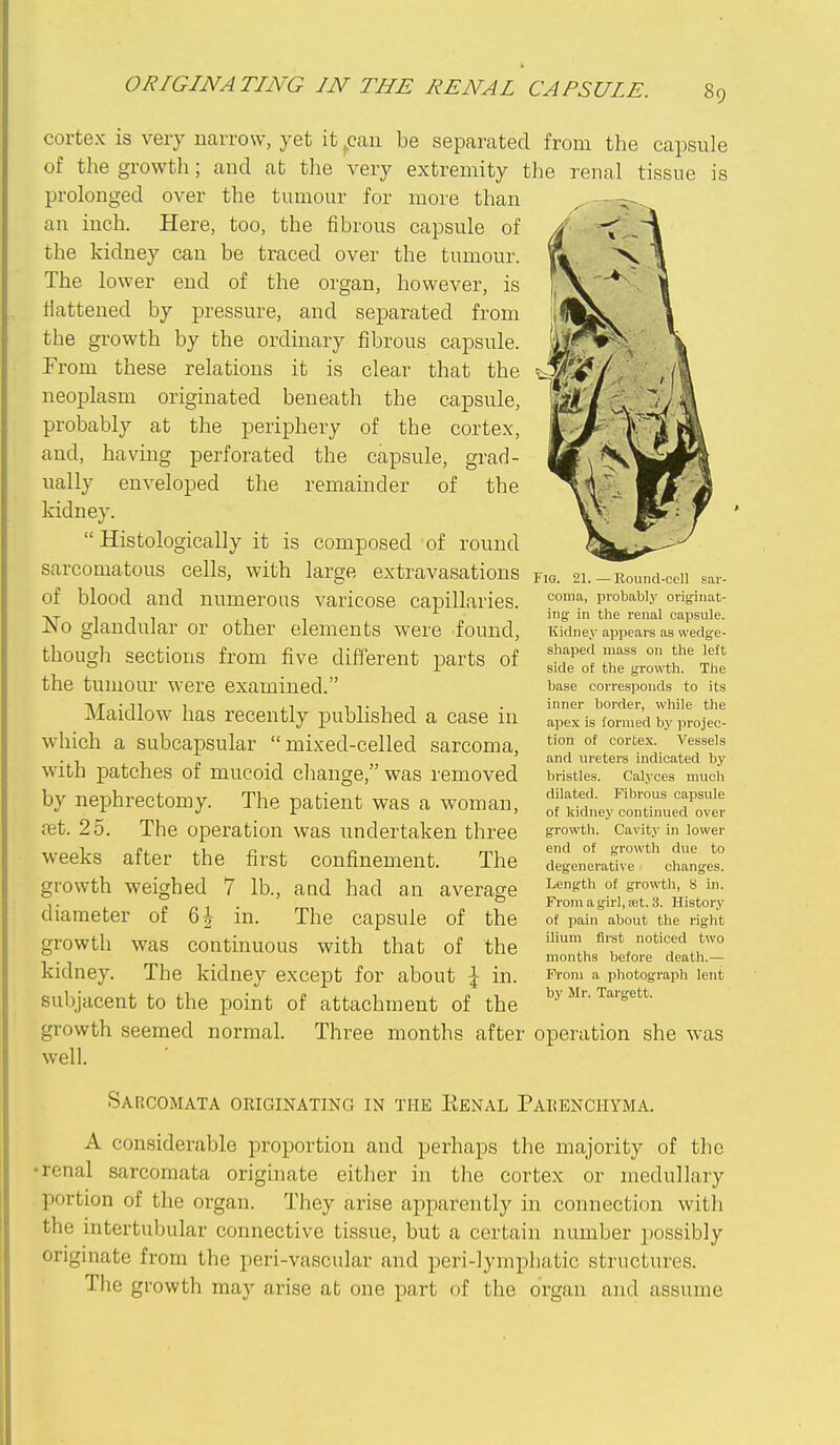ORIGINATING IN THE RENAL CAPSULE. cortex is very narrow, yet it ,cau be separated from the capsule of the growth; aud at tlie very extremity the renal tissue is prolonged over the tumour for more than an inch. Here, too, the fibrous capsule of the kidney can be traced over the tumour. The lower end of the organ, however, is flattened by pressure, and separated from the growth by the ordinary fibrous capsule. From these relations it is clear that the neoplasm originated beneath the capsule, probably at the periphery of the cortex, and, having perforated the capsule, grad- ually enveloped the remainder of the kidney. Histologically it is composed of round sarcomatous cells, with large extravasations f,g. 21. -Round-ceii of blood and numerous varicose capillaries. No glandular or other elements were found, though sections from five different parts of the tumom- were examined. Maidlow has recently published a case in which a subcapsular mixed-celled sarcoma, with patches of mucoid change, was removed by nephrectomy. The patient was a woman, fet. 25. The operation was undertaken three weeks after the first confinement. The growth weighed 7 lb., aud had an average diameter of 6| in. The capsule of the growth was continuous with that of the kidney. The kidney except for about \ in. subjacent to the point of attachment of the growth seemed normal. Three months after operation she was well. Sarcomata originating in the Eenal Paeenchyma. A considerable proportion and perhaps the majority of the •renal sarcomata originate either in the cortex or medullary portion of the organ. They arise apparently in connection with the intertubular connective tissue, but a certain number possibly originate from the peri-vascular and peri-lymphatic structures. The growth may arise at one part of the organ and assume coma, probably originat- ing: in the renal capsule. Kidney appears as wedge- shaped mass on the left side of the growth. The base corresponds to its inner border, while the apex is formed by projec- tion of cortex. Vessels and ureters indicated by bristles. Calyces much dilated. Fibrous capsule of kidney continued over growth. Cavity in lower end of growth due to degenerative changes. Length of growth, 8 in. From a girl, set. 3. History of pain about the right ilium first noticed two months before death.— From a photograph lent by Mr. Targett.