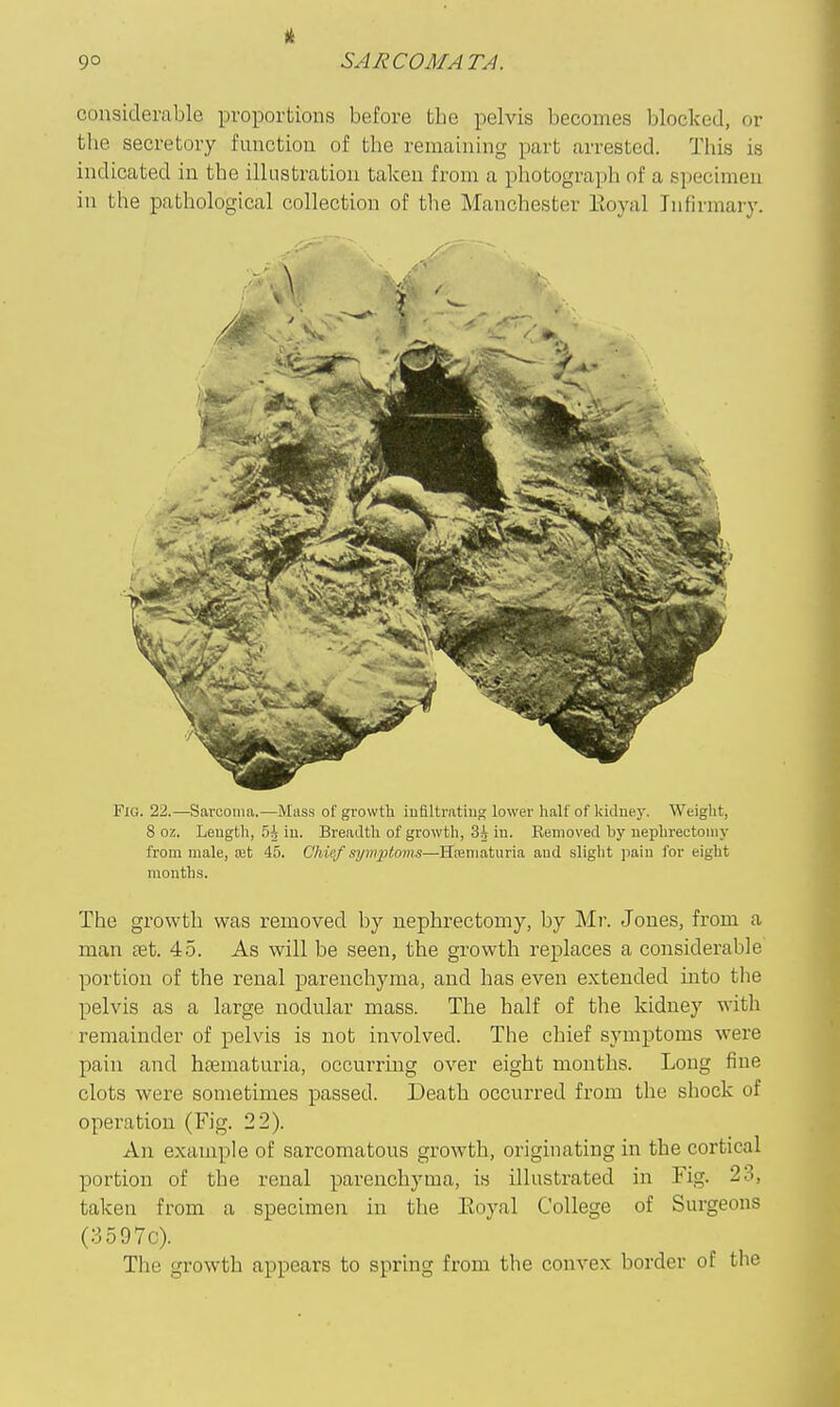 considerable proportions before the pelvis becomes blocked, or the secretory function of the remaining part arrested. This is indicated in the illustration taken from a photograph of a specimen in the pathological collection of the Manchester Eoyal Infirmary. Fio. 22.-—Sarcoma.—Muss of growth iufiltratiug lower half of kidney. Weight, 8 oz. Length, 5i iu. Breadth of growth, Sj iu. Bemoved by nephrectomy from male, a;t 45. Chief symptoms—Hreniaturia and slight ])ain for eight months. The growth was removed by nephrectomy, by Mr. Jones, from a man tet. 45. As will be seen, the growth replaces a considerable portion of the renal parenchyma, and has even extended mto the pelvis as a large nodular mass. The half of the kidney with remainder of pelvis is not involved. The cliief symptoms were pain and hematuria, occurring over eight months. Long fine clots were sometimes passed. Death occurred from the shock of operation (Fig. 22). An example of sarcomatous growth, originating in the cortical portion of the renal parenchyma, is illustrated in Fig. 23, taken from a specimen in the Koyal College of Surgeons (:3597c). The growth appears to spring from the convex border of the