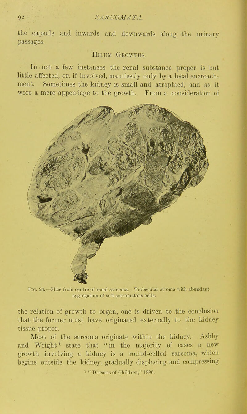 the capsule and inwards and downwards along the urmary passages. HiLUM Growths. In not a few instances the renal substance proper is but little affected, or, if involved, manifestly only by a local encroach- ment. Sometimes the kidney is small and atrophied, and as it were a mere appendage to the growth. From a consideration of (4 Fig. 24.—Slice from centre of renal sarcoma. • Trabecular stroma with abundant aggregatiou of soft sarcomatous cells. the relation of growth to organ, one is driven to the conclusion that the former must have originated externally to the kidney tissue proper. Most of the sarcoma originate within the kidney. Ashby and Wright ^ state that  in the majority of cases a new growth involving a kidney is a round-celled sarcoma, which begins outside the kidney, gradually displacing and compressing 1  Diseases of Cliiklren, 1896.