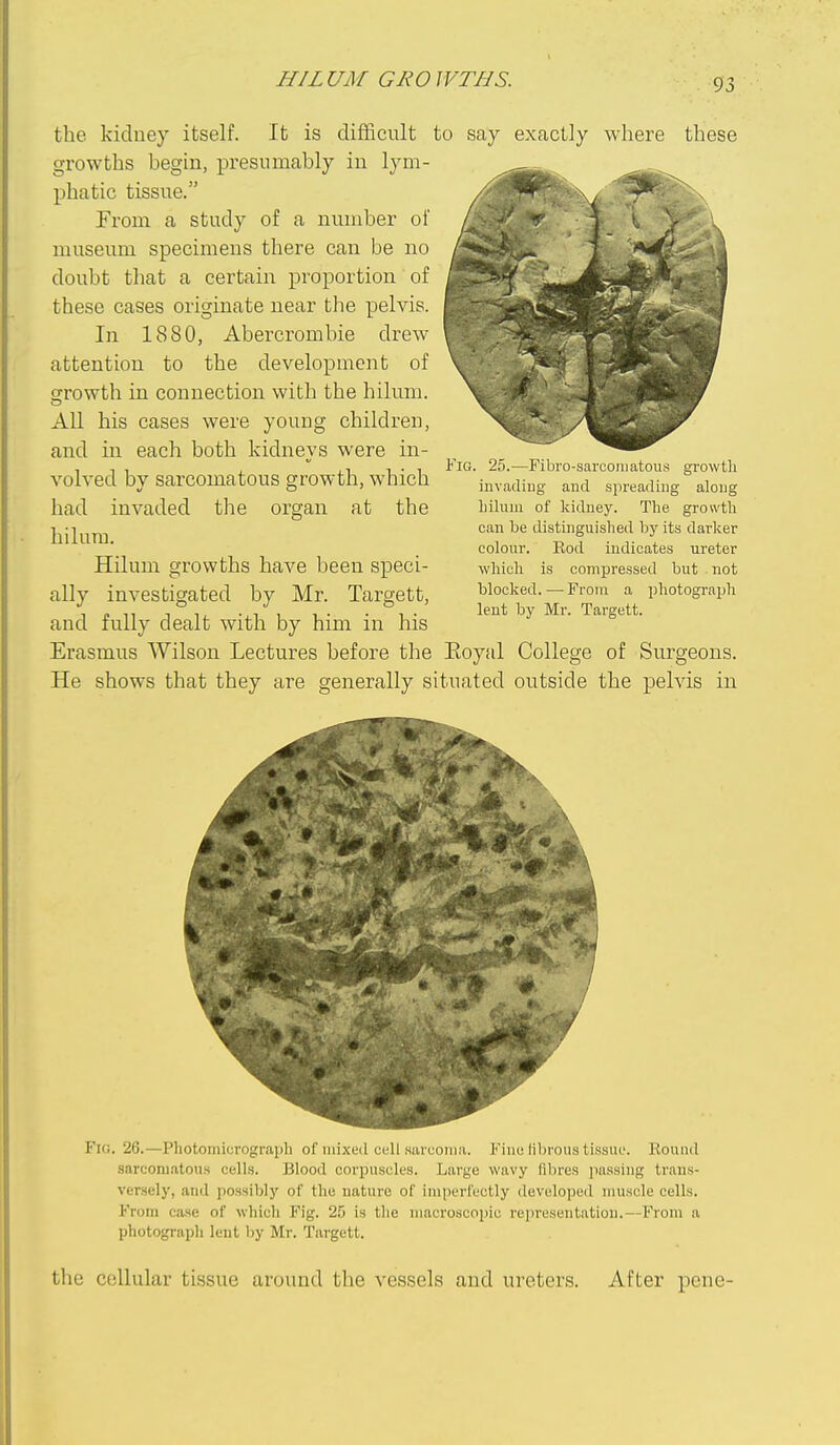 HIL UM GRO WTHS. the kidney itself. It is difficult growths begin, presumably in lym- phatic tissue. From a study of a number of museum specimens there can be no doubt that a certain proportion of these cases originate near the pelvis. In 1880, Abercrombie drew attention to the development of cjrowth in connection with the hilum. All his cases were young children, and in each both kidneys were in- volved by sarcomatous growth, which had invaded the organ at the hilum. Hilum growths have been speci- ally investigated by Mr. Targett, and fully dealt with by him in his Erasmus Wilson Lectures before the He shows that they are generally s to say exactly where these ■3, ^ Fig. 25.—Fibro-sarconiatous growth invading and spreading along liihim of kidney. The growth can be distinguished by its darker colour. Rod indicates ureter which is compressed but not blocked. — From a photograph lent by Mr. Targett. Eoyal College of Surgeons, ituated outside the pelvis in Fig. 26.—Photomicrograph of mixed cell sarcoma. Fine librous tissue. Kouud sarcomatous cells. Blood corpuscles. Large wavy fibres passing trans- versely, and possibly of the nature of imperfectly developed muscle cells. From case of which Fig. 25 is the macroscopic rejiresentatiou.—From a photograph lent by Mr. Targett. the cellular tissue around the vessels and ureters. After pene-