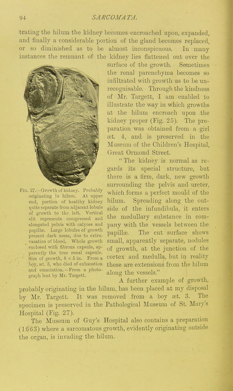 trating the hilum the kidney becomes encroached upon, expanded, and finally a considerable portion of the gland becomes replaced, or so diminished as to be almost inconspicuous. In many instances the remnant of the kidney lies fiattened out over the surface of the growth. Sometimes the renal parenchyma becomes so infiltrated with growth as to be un- recognisable. • Through the kindness of Mr. Targett, I am enabled to illustrate the way in which growths at the hilum encroach upon the kidney proper (Fig. 25). The pre- paration was obtained from a girl set. 4, and is preserved in the Museum of the Children's Hospital, Great Ormond Street.  The kidney is normal as re- gards its special structure, but there is a firm, dark, new growth surrounding the pelvis and ureter, which forms a perfect mould of the hilum. Spreading along the out- side of the infundibula, it enters the medullary substance in com- pany with the vessels between the papillte. The cut surface shows small, apparently separate, nodules of growth, at the junction of the cortex and medulla, but in reality these are extensions from the hilum along the vessels. A further example of growth, probably originating in the hilum, has been placed at my disposal by Mr. Targett. It was removed from a boy eet. 3. The specimen is preserved in the Pathological Museum of St. Mary's Hospital (Fig. 27). The Museum of Guy's Hospital also contains a preparation (1663) where a sarcomatous growth, evidently originating outside the organ, is invading the hilum. Fig. 27.'—Q-rowth ol'kidney. Probably originating in hilum. At upper end, portion of healthy kidney quite separate from adjacent lobule of growth to Ihs left. Vertical slit represents compressed and elongated pelvis with calyces and papillaj. Large lobules of growth present dark areas, due to extra- vasation of blood. Whole growth enclosed with fibrous capsule, ap- parently the true renal capsule. Size of growth, 8x5 in. From a boy, fet. 3, who died of exhaustion and emaciation.—From a photo- graph lent by Mr. Targett.