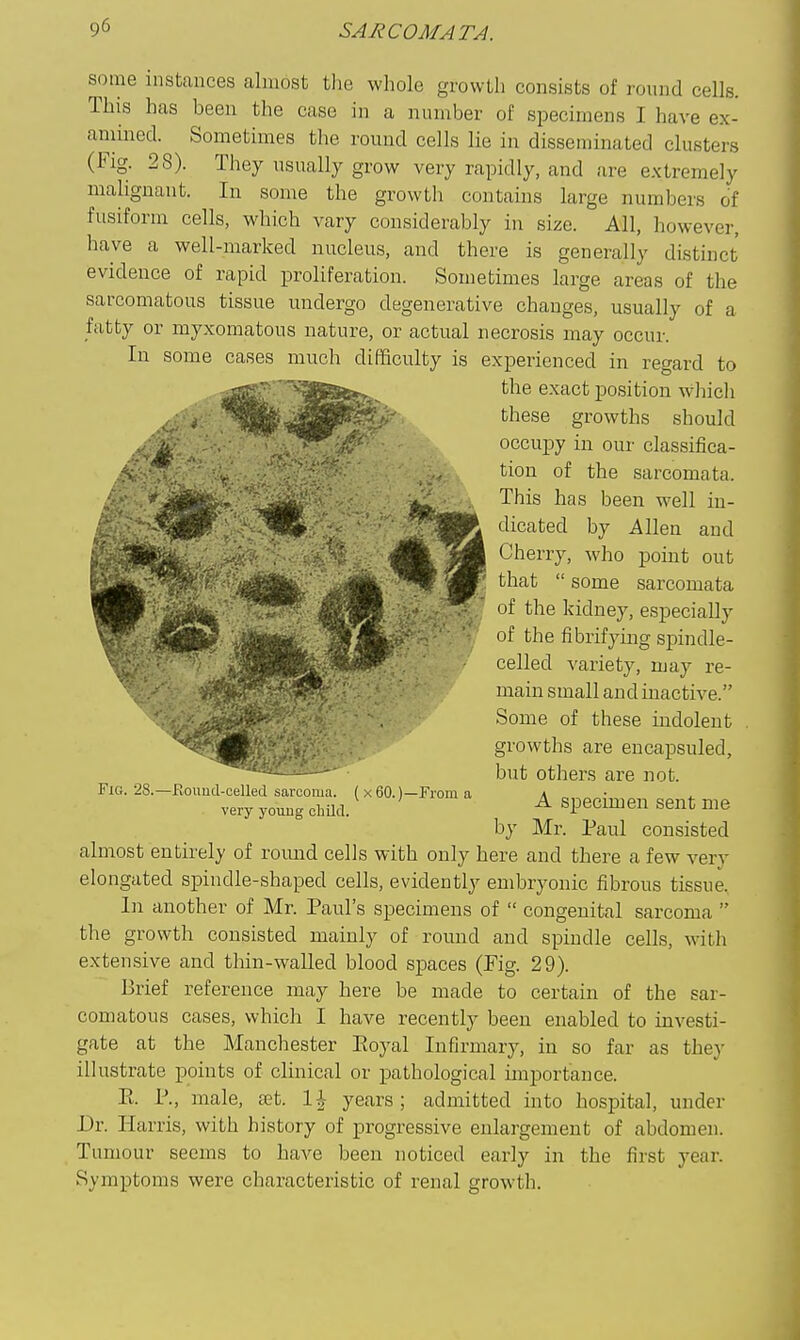 some instances almost tlio whole growth consists of round cells. This has been the case in a number of specimens I have ex- aniined. Sometimes the round cells lie in disseminated clusters (Fig. 28). They usually grow very rapidly, and are extremely mahgnant. In some the growth contains large numbers of fusiform cells, which vary considerably in size. All, however, have a well-marked nucleus, and there is generally distinct evidence of rapid proliferation. Sometimes large areas of the sarcomatous tissue undergo degenerative changes, usually of a fatty or myxomatous nature, or actual necrosis may occur. In some cases much difficulty is experienced in regard to the exact position wliicli these growths should occupy in our classifica- tion of the sarcomata. This has been well in- dicated by Allen and Cherry, who point out that  some sarcomata of the kidney, especially of the fibrifj'hig spindle- celled variety, may re- main small and inactive. Some of these indolent growths are encapsuled, but others are not. A specimen sent me by Mr. Paul consisted almost entirely of romid cells with only here and there a few very elongated spindle-shaped cells, evidently embryonic fibrous tissue. In another of Mr. Paul's specimens of  congenital sarcoma  the growth consisted mainly of round and spindle cells, with extensive and thin-walled blood spaces (Pig. 29). Brief reference may here be made to certain of the sar- comatous cases, which I have recently been enabled to investi- gate at the Manchester Eoyal Infirmary, in so far as they illustrate points of clinical or pathological importance. E. P., male, £et. 1^ years; admitted into hospital, under Dr. Harris, with history of progressive enlargement of abdomen. Tumour seems to have been noticed early in the first year. Symptoms were characteristic of renal growtli. Fig. 28.—Roimd-celled sarcoma. ( x 60.)—From a very youug child.