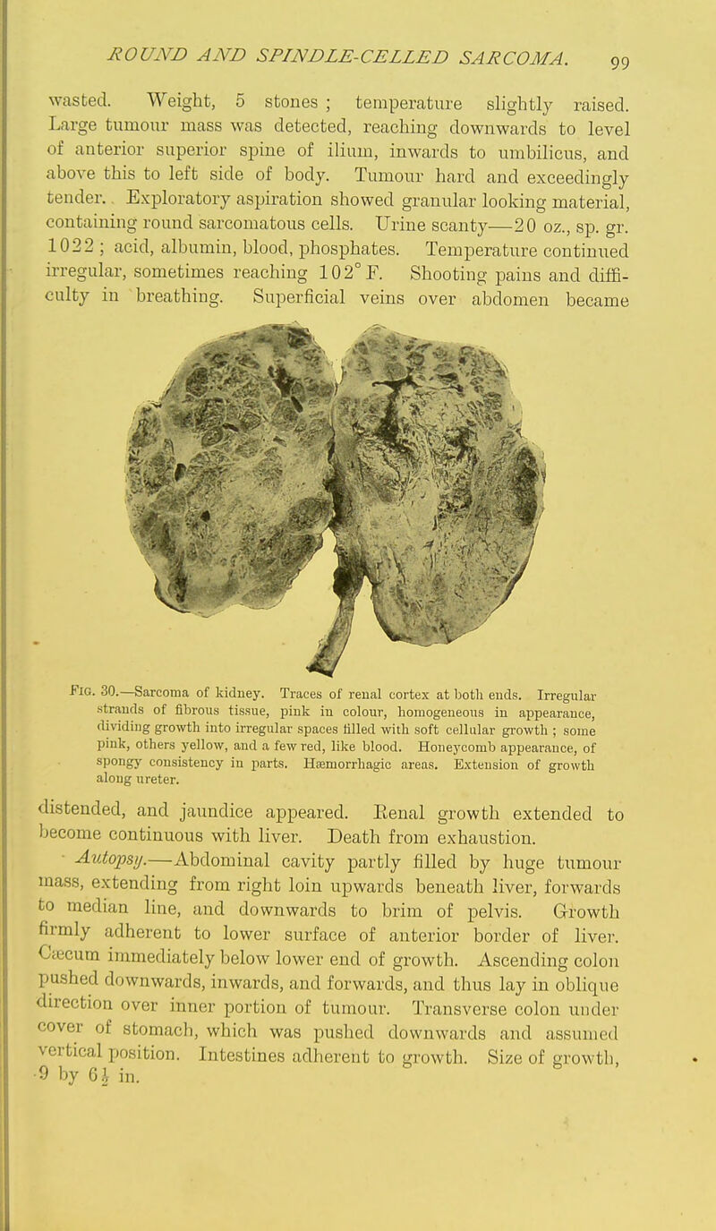 wasted. Weight, 5 stones ; temperature slightly raised. Large tumour mass was detected, reaching downwards to level of anterior superior spine of ilium, inwards to umbilicus, and above this to left side of body. Tumour hard and exceedingly tender.. E.xploratory aspiration showed granular looking material, containing round sarcomatous cells. Urine scanty—20 oz., sp. gr. 1022 ; acid, albumin, blood, phosphates. Temperature continued irregular, sometimes reaching 102°F. Shooting pains and diffi- culty in breathing. Superficial veins over abdomen became Fig. 30.—Sarcoma of kiduey. Traces of reual cortex at botli ends. Irregular strands of fibrous tissue, piuk iu colour, homogeneous in appearance, dividing growth into irregular spaces tilled with soft cellular growth ; some pink, others yellow, and a few red, like blood. Honej'comb appearance, of spongy consistency in parts. Hemorrhagic areas. E.xtension of growth along ureter. distended, and jaundice appeared. Eenal growth extended to become continuous with liver. Death from exhaustion. ■ Autopsy.—Abdominal cavity partly filled by huge tumour mass, extending from right loin upwards beneath liver, forwards to median line, and downwards to brim of pelvis. Growth firmly adherent to lower surface of anterior border of livei-. Ctecum immediately below lower end of growth. Ascending colon pushed downwards, inwards, and forwards, and thus lay in oblique direction over inner portion of tumour. Transverse colon under cover of stomach, which was pushed downwards and assumed vertical position. Intestines adherent to growth. Size of growth, ■9 by 6i in. 6 s ,