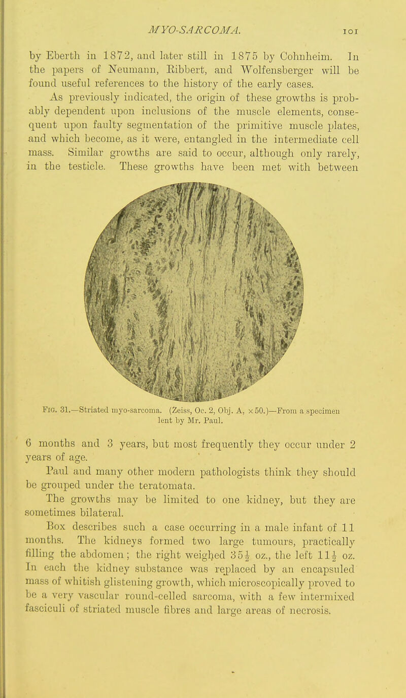 by Eberth in 1872, and later still in 1875 by Cohnheim. In the papers of Neumann, Eibbert, and Wolfensberger will be found useful references to the history of the early cases. As previously indicated, the origin of these growths is prob- ably dependent upon inclusions of the muscle elements, conse- quent upon faulty segmentation of the primitive muscle plates, and which become, as it were, entangled in the intermediate cell mass. Similar growths are said to occur, although only rarely, in the testicle. These growths have been met with between Fig. 31.—Striated niyo-sarcoma. (Zeiss, Oc\ 2, Obj. A, x 50.)—From a specimen lent by Mr. Paul. 6 months and 3 years, but most frequently they occur under 2 years of age. Paul and many other modern pathologists think they should be grouped under the teratomata. The growths may be limited to one kidney, but they are sometimes bilateral. Box describes such a case occurring in a male infant of 11 months. The kidneys formed two large tumours, practically fining the abdomen; the right weighed 35^ oz., the left Hi- oz. In each the kidney substance was rejDlaced by an encapsuled mass of whitish glistening growth, which microscopically proved to be a very vascular round-celled sarcoma, with a few intermixed fasciculi of striated muscle fibres and large areas of necrosis.
