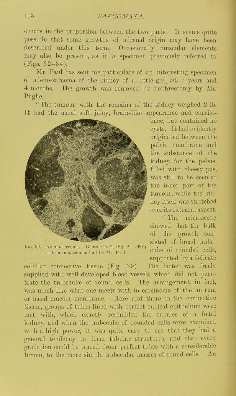 occurs in the proportion between the two parts. It seems quite possible that some growths of adrenal origin may have been described under this term. Occasionally muscular elements may also be present, as in a specimen previously referred to (Figs. 32-34). Mr. Paul has sent me xmrticulars of an interesting specimen of adeno-sarcoma of the kidney of a little girl, tet. 2 years and 4 months. The growth was removed by nephrectomy by Mr. Pughe.  The tumour with the remains of the kidney weighed 2 lb. It had the usual soft, juicy, brain-like appearance and consist- ence, but contained no cysts. It had evidently originated between the pelvic membrane and the substance of the kidney, for the pelvis, filled with cheesy pus, was still to be seen at the inner part of the tumour, while the kid- ney itself was stretched over its external aspect.  The microscope showed that the bulk of the growth con- sisted of broad trabe- FlG. 39.—Adeno-sarcoma. (Zeiss, Oc. 2, Obi. A, x60.) , „ i i n -From a specimen lent by Mv. Paul. C^^^fe of rouuded Cells, supported by a delicate cellular connective tissue (Fig. 39). The latter was freely supplied with well-developed blood vessels, which did not pene- trate the trabeculjE of round cells. The arrangement, in fact, was much like what one meets with in carcinoma of the antrum or nasal mucous membrane. Here and there in the connective tissue, groups of tubes lined with perfect cubical epithelium were met with, which exactly resembled the tubules of a foetal kidney, and when the trabecul;^ of rounded cells were examined with a high power, it was quite easy to see that they had a general tendency to form tubular structures, and that every gradation could be traced, from perfect tubes with a considerable lumen, to the more simple trabecular masses of round cells. -An