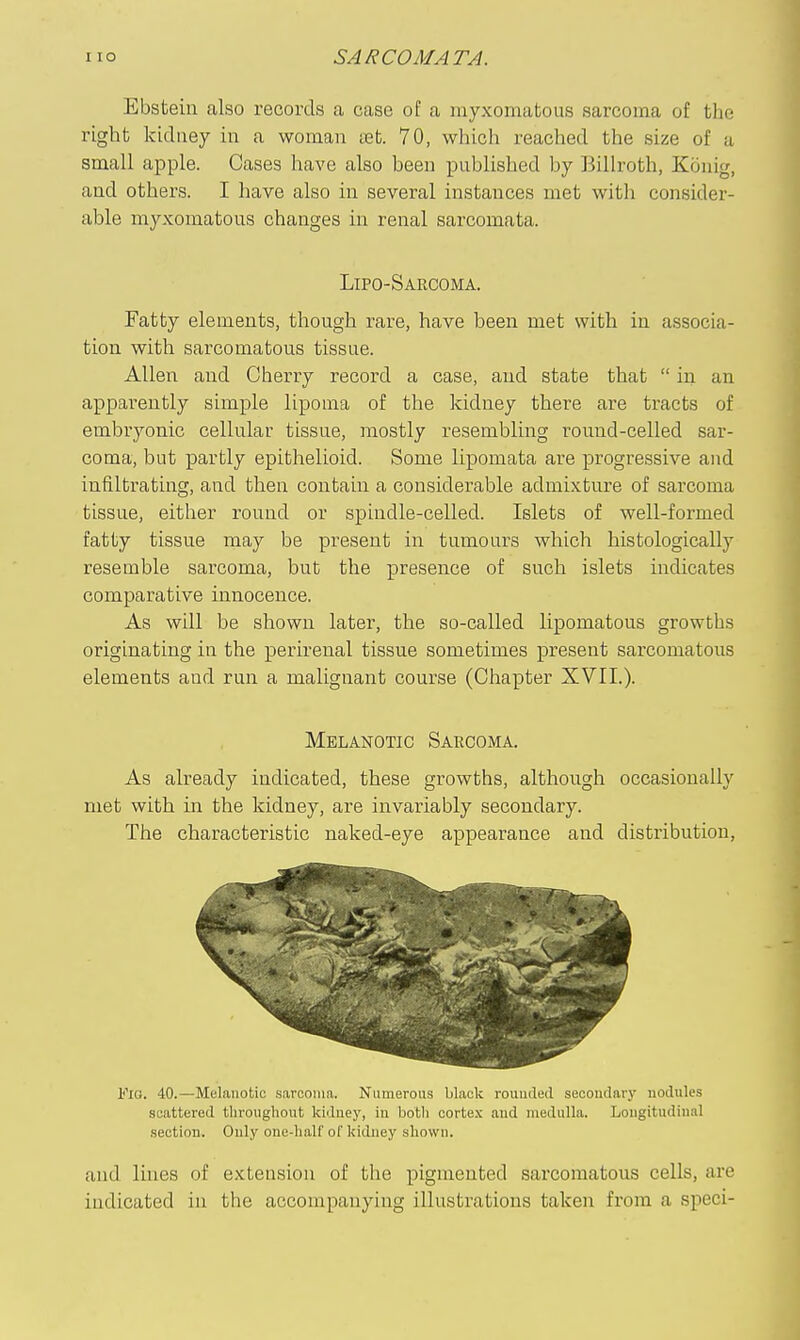 Ebstein also records a case of a myxomatous sarcoma of the right kidney in a woman set. 70, which reached the size of a small apple. Cases have also been published by Billroth, Konig, and others. I have also in several instances met with consider- able myxomatous changes in renal sarcomata. Fatty elements, though rare, have been met with in associa- tion with sarcomatous tissue. Allen and Cherry record a case, and state that  in an appai-ently simple lipoma of the kidney there are tracts of embryonic cellular tissue, mostly resembling round-celled sar- coma, but partly epithelioid. Some lipomata are progressive and infiltrating, and then contain a considerable admixture of sarcoma tissue, either round or spindle-celled. Islets of well-formed fatty tissue may be present in tumours which histologically resemble sarcoma, but the presence of such islets indicates comparative innocence. As will be shown later, the so-called lipomatous growths originating in the perirenal tissue sometimes present sarcomatous elements and run a malignant course (Chapter XVII.). As already indicated, these growths, although occasionally met with iai the kidney, are invariably secondary. The characteristic naked-eye appeai-ance and distribution, 1<'I0. 40.—Melanotic sarooina. Numerous black rouuded secondary nodules scattered throughout kidney, in botli corte.x and medulla. Longitudinal section. Only one-half of kidney shown. and lines of extension of the pigmented sarcomatous cells, are indicated in the accompanying illustrations taken from a speci- Lipo-Sarcoma. Melanotic Sarcoma.