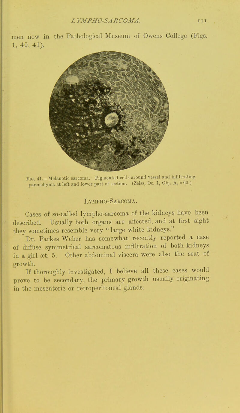 luen now in the Pathological Museum of Owens College (Figs. 1, 40, 41). Fig. 41.—Melanotic sarcoma. Pigmented cells around vessel and infiltrating parenchyma at left and lower part of section. (Zeiss, Oc. 1, Obj. A, x 60.) Lympho-Sakcoma. Cases of so-called lympho-sarcoma of the kidneys have been described. Usually both organs are affected, and at first sight they sometimes resemble very  large white kidneys. Dr. Parkes Weber has somewhat recently reported a case of diffuse symmetrical sarcomatous infiltration of both kidneys in a girl fet. 5. Other abdominal viscera were also the seat of growth. If thoroughly investigated, I believe all these cases would prove to be secondary, the primary growth usually originating in the mesenteric or retroperitoneal glands.