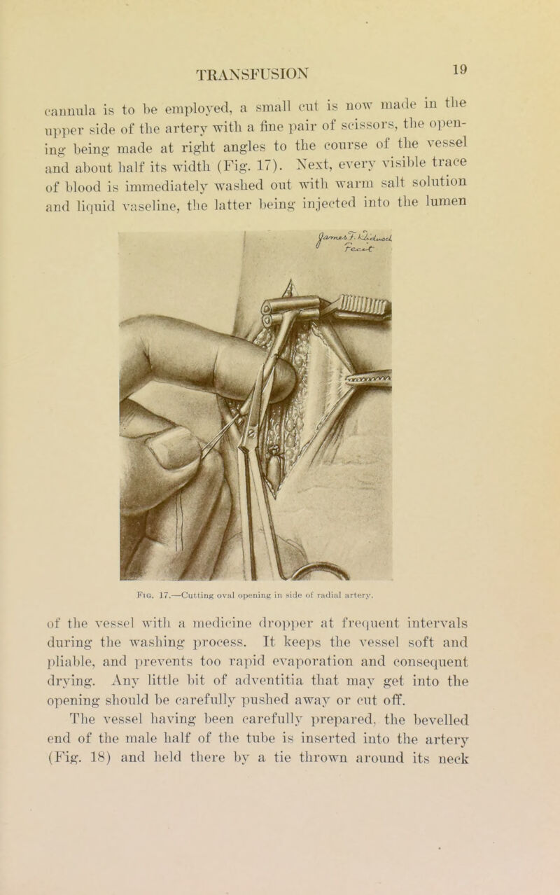 cannula is to be employed, a small ent is now made in the upper side of the artery with a fine pair of scissors, the open- ing being made at right angles to the course of the vessel and a.bout half its width (Fig. 17). Next, every visible trace of blood is immediately washed out with warm salt solution and liquid vaseline, the latter being injected into the lumen of the vessel with a medicine drop])er at frequent intervals during the washing process. It keeps the vessel soft and pliable, and prevents too rapid evaporation and consequent drying. Any little bit of adventitia that may get into the opening should be carefully pushed away or cut off. The vessel having l)een carefully ])repared, the bevelled end of the male half of the tube is inserted into the artery (Fig. 18) and held there by a tie thrown around its neck FtG. 17.—Cutting oval opening in side of radial artery.