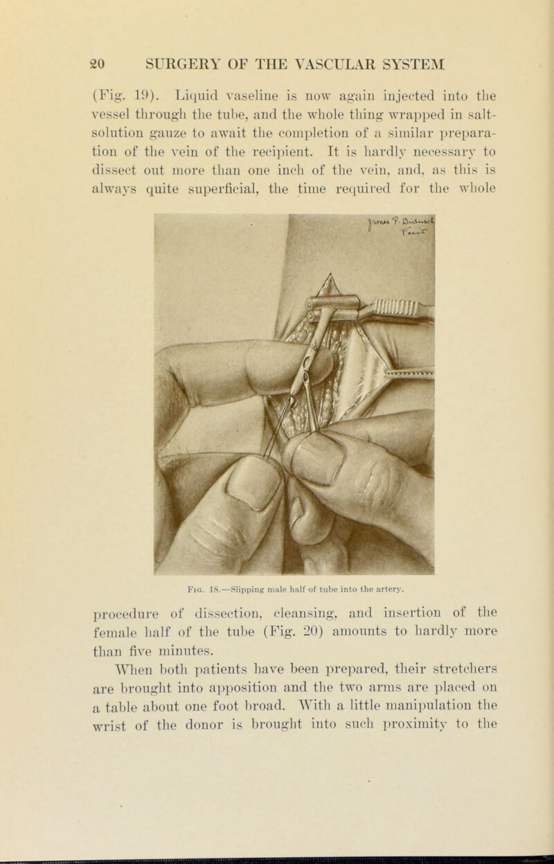 (Fig. 19). Liquid vaseline is now again injected into the vessel through the tube, and the whole thing wrapped in salt- solution gauze to await the completion of a similar prepara- tion of the vein of the recipient. It is hardly necessary to dissect out more than one inch of the vein, and, as this is always quite superficial, the time required for the whole Fig. 18.—Slipping male half of tube into the artery. procedure of dissection, cleansing, and insertion of the female half of the tube (Fig. 20) amounts to hardly more than five minutes. When both patients have been prepared, their stretchers are brought into apposition and the two arms are placed on a table about one foot broad. With a little manipulation the wrist of the donor is brought into such proximity to the