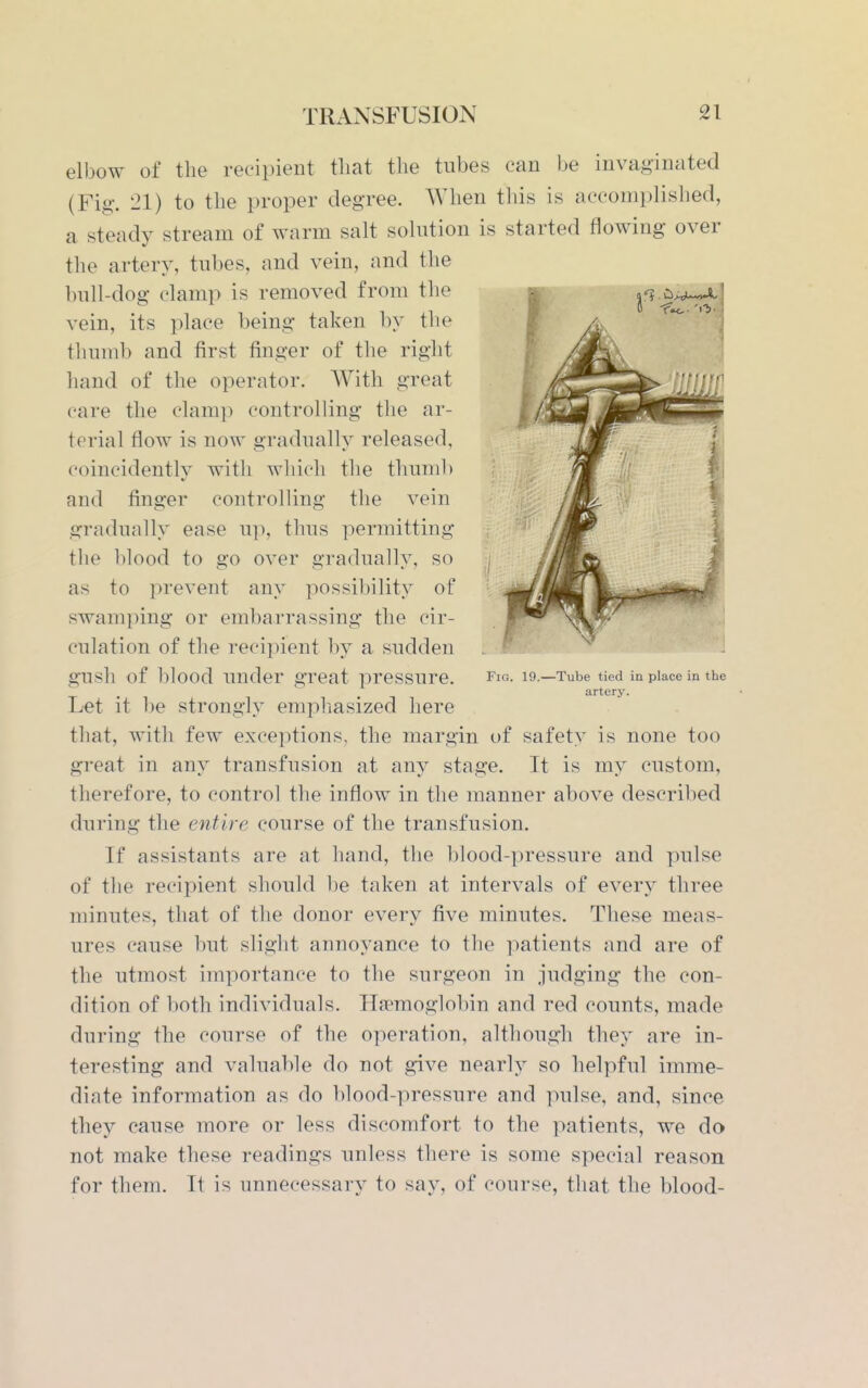 elbow of the recipient that the tubes can be invaginated (Fig. 21) to the proper degree. When this is accomplished, a steady stream of warm salt solution is started flowing over the artery, tubes, and vein, and the bull-dog clamp is removed from the vein, its place being taken by the thumb and first finger of the right hand of the operator. With great care the clamp controlling the ar- terial flow is now gradually released, coincidently with which the thumi) and finger controlling the vein gradually ease u]i, thus permitting the blood to go over gradually, so as to prevent any possibility of swamping or embarrassing the cir- culation of the recipient by a sudden gush of lilood under great pressure, fiq- i9.—Tube tied in place in the !l . . artery. Lfet it be strongly emphasized here that, with few exceptions, the margin of safety is none too great in any transfusion at any stage. It is my custom, therefore, to control the inflow in the manner above described during the entire course of the transfusion. If assistants are at hand, the blood-pressure and pulse of the recipient should l)e taken at intervals of every three minutes, that of the donor every five minutes. These meas- ures cause but slight annoyance to the patients and are of the utmost importance to the surgeon in judging the con- dition of both individuals. Ha^moglol)in and red counts, made during the course of the operation, although they are in- teresting and valuable do not give nearly so helpful imme- diate information as do blood-pressure and pulse, and, since they cause more or less discomfort to the patients, we do not make these readings unless there is some special reason for them. It is unnecessary to say, of course, that the blood-
