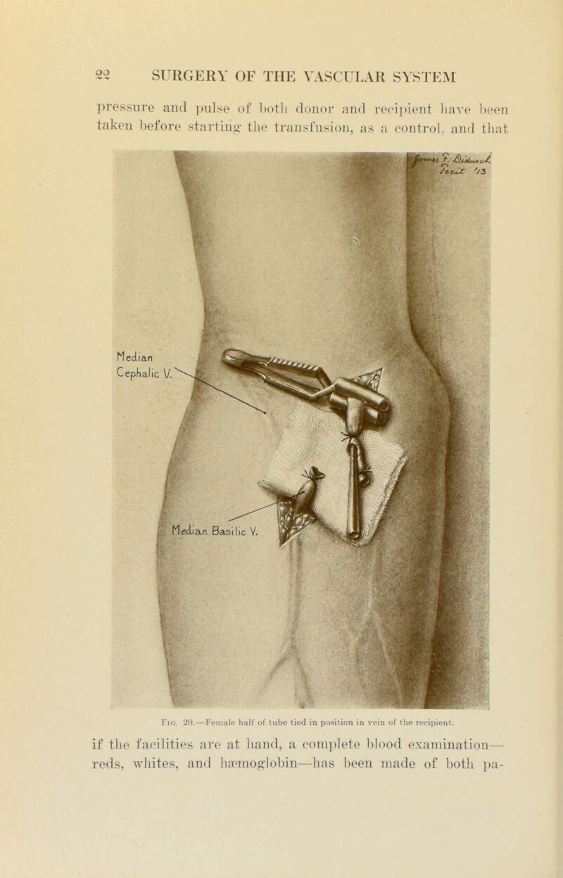 pressure and ]mlse of l)otli donor and recii)ient have been taken liefore starting- the transfusion, as a control, and that V J Acci Fig. 20.—-Female half of tube tied in position in vein of the recipient. if the facilities are at hand, a complete blood examination— reds, whites, and hapmoglobin—has been made of both pa-