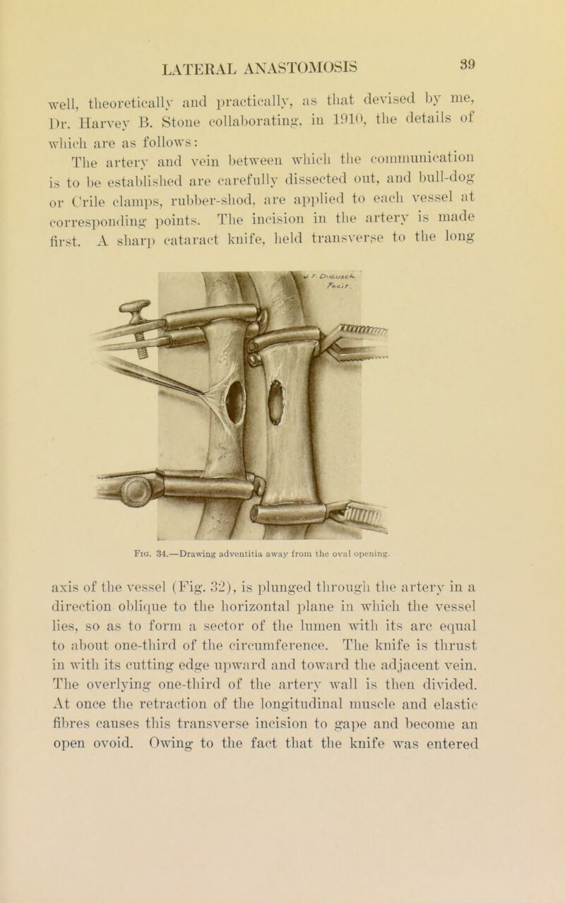 well, theoretically and practically, as that devised by me, Dr. Harvey B. Stoue collaborating, in 1910, the details of which are as follows: The artery and vein between which the commnnication is to be established are carefully dissected out, and bull-dog or (Vile clamps, rubber-shod, are applied to each vessel at corresponding points. The incision in the artery is made first. A sharp cataract knife, held transverse to the long Fig. 34.—Drawing adventitia away from the oval opening. axis of the vessel (Fig. 32), is plunged through the arterj' in a direction oblique to the horizontal plane in which the vessel lies, so as to form a sector of the lumen with its arc equal to about one-third of the circumference. The knife is thrust in with its cutting edge upward and toward the adjacent vein. The overlying one-third of the artery wall is then divided. At once the retraction of the longitudinal muscle and elastic fibres causes this transverse incision to gape and become an open ovoid. Owing to the fact that the knife was entered