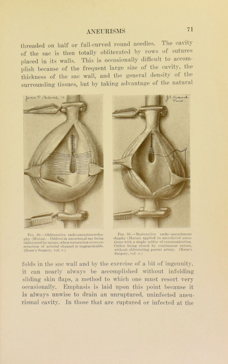 threaded on half or full-curved round needles. The cavity of the sac is then totally obliterated by rows of sutures placed in its walls. This is occasionally difficult to accom- plish because of the fre(iuent larg-e size of the cavity, the thickness of the sac wall, and the o-eneral density of the surrounding tissues, but by taking advantage of the natural Fig. 50.—Obliterative endo-aneurisinorrha- phy (Matas). Orifices in anourisinal sac Ijeirig obliterated by suture, when restoration or recon- struction of arterial channel is impracticable. (Keen's Surgery, vol. v.) Fig. 51.—Restorative endo-aneurismor- rhfiphy (Matas) applied to sacculated aneu- risms with a single orifice of communication. Orifice being clo.sed by continuous suture, without oliliterating parent artery. (Keen's Surgery, vol. v.) folds in the sac wall and by the exercise of a bit of ingenuity, it can nearly always be accomplished without infolding sliding skin flaps, a method to which one must resort very occasionally. Emphasis is laid npon this point because it is always unwise to drain an unruptured, uninfected aneu- rismal cavity. In those that are ruptured or infected at the