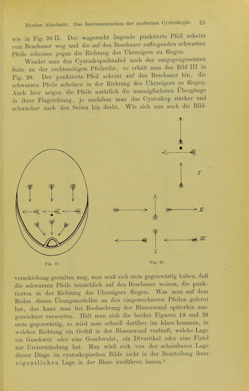 wie in Fig. 20 II. Der wagereclit liegende punktierte Pfeil scheint vom Beschauer weg und die auf den Beschauer zufliegenden schwarzen Pfeile scheinen gegen die Richtung des Uhrzeigers zu fliegen. Wendet man den Cystoskopschnabel nach der entgegengesetzten Seite zu der rechtsseitigen Pfeilreihe, so erhält man das Bild III m Fig. 20. Der pmiktierte Pfeil scheint auf den Beschauer hin, die schwarzen Pfeile scheinen in der Richtung des Uhrzeigers zu fliegen. Auch hier zeigen die Pfeile natürlich die mannigfachsten Übergänge in ihrer Flugrichtung, je nachdem man das Cystoskop stärker und schwächer nach den Seiten hin dreht. Wie sich nun auch die Bild- Ii^ A TL Fig. 19. Fig. 20. Verschiebung gestalten mag, man muß sich stets gegenwärtig halten, daß die schwarzen Pfeile tatsächlich auf den Beschauer weisen, die punk- tierten in der Richtung des Uhrzeigers fliegen. Was man auf dem Boden dieses Übungsmodelles an den eingezeichneten Pfeilen gelernt hat, das kann man bei Beobachtung der Blasenwand späterhin aus- gezeichnet verwerten. Hält man sich die beiden Figuren 19 und 20 stets gegenwärtig, so wird man schnell darüber ins klare kommen, in welcher Richtung ein Gefäß in der Blasenwand verläuft, welche Lage ein Geschwür oder eine Geschwulst, ein Divertikel oder eine Fistel zur Uretermündung hat. Man wird sich von. der scheinbaren Lage dieser Dinge im cystoskopischen Bilde nicht in der Beurteilung ihrer eigentlichen Lage in der Blase irreführen lassen.