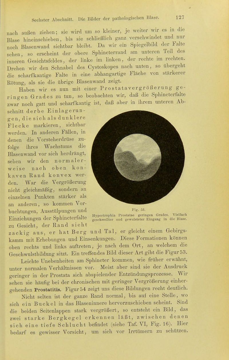 nach außen ziehen; sie wird um so kleiner, je weiter wir es in die Blase hineinschieben, bis sie schließlich ganz verschwindet und nur noch Blasenwand sichtbar bleibt. Da wir ein Spiegelbild der Falte sehen, so erscheint der obere Sphincterrand am unteren Teil des inneren Gesichtsfeldes, der linke im linken, der rechte im rechten. Drehen wir den Schnabel des Cystoskopes nach unten, so übergeht die scharfkantige Falte in eine abhangartige Fläche von stärkerer Rötung, als sie die übrige Blasenwand zeigt. Haben wir es nun mit einer Prostatavergrößerung ge- ringen Grades zu tun, so beobachten wir, daß die Sphincterfalte zwar noch gatt und scharfkantig ist, daß aber in ihrem unteren Ab- schnitt derbe Einlagerun- gen, die sich als dunklere Flecke markieren, sichtbar werden. In anderen Fällen, in denen die Vorsteherdrüse zu- folge ihres Wachstums die Blasenwand vor sich herdrängt, sehen wir den normaler- weise nach oben kon- kaven Rand konvex wer- den. War die Vergrößerung nicht gleichmäßig, sondern an einzehaen Punkten stärker als an anderen, so kommen Vor- buchtungen, Ausstülpungen und Einziehungen der Sphincterfalte zu Gesicht, der Rand sieht zackig aus, er hat Berg und Tal, er gleicht einem Gebirgs- kamm mit Erhebungen und Einsenkungen. Diese Forma,tionen können oben rechts und links auftreten, je nach dem Ort, an welchem die Geschwulstbildung sitzt. Ein treffendes Bild dieser Art gibt die Figur 53. Leichte Unebenheiten am Sphincter kommen, wie früher erwähnt, unter normalen Verhältnissen vor. Meist aber sind sie der Ausdruck geringer in der Prostata sich abspielender Entzündungsprozesse. Wir sehen sie häufig bei der chronischen mit geringer Vergrößerung eiuher- gehenden Prostatitis. Figur 54 zeigt uns diese Bildungen recht deutlich. Nicht selten ist der ganze Rand normal, bis auf eine Stelle, wo sich ein Buckel in das Blaseninnere hervorzuschieben scheint. Sind die beiden Seitenlappen stark vergrößert, so entsteht ein Bild, das zwei starke Bergkegel erkennen läßt, zwischen denen sich eine tiefe Schlucht befindet (siehe Taf. VI, Fig. 16). Hier bedarf es gewisser Vorsicht, um sich vor Irrtümern zu schützen. Fig. 53. Hypertrophia Prostatae geringen Grades. Vielfach geschwellter und gewulsteter Eingang in die Blase.