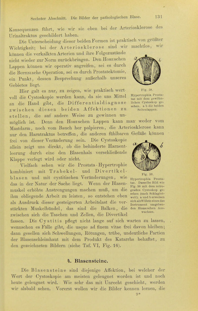 Fig. 58. Hypertrophia Prosta- tae mit dem gewöhn- lichen Cystoskop ge- sehen, a b die beiden Seitenlappen. Konsequenzen fährt, wie wir sie eben bei der Arteriosklerose des Urinaltraktus geschildert haben. Die Unterscheidung dieser beiden Formen ist praktisch von größter Wichtigkeit; bei der Arteriosklerose sind wir machtlos, wir können die verkalkten Arterien und ihre Folgezustände nicht wieder zui-Norm zui-ückbringen. Den Home sehen Lappen können wir operativ angreifen, sei es durch die BoTTmische Operation, sei es durch Prostatektomie, ein Punkt, dessen Besprechung außerhalb unseres Gebietes liegt. Hier galt es nur, zu zeigen, wie praktisch wert- voll die Cystoskopie werden kann, da sie uns Mittel an die Hand gibt, die Differentialdiagnose zwischen diesen beiden Affektionen zu stellen, die auf andere Weise zu gewinnen un- möglich ist. Denn den Home sehen Lappen kann man- weder vom Mastdarm, noch vom Bauch her palpieren, die Arteriosklerose kann nur den Harntraktus betreffen, die anderen fühlbaren Gefäße können frei von dieser Veränderung sein. Die Cystoskopie allein zeigt uns direkt, ob die behinderte Harnent- leerung durch eine den Blasenhals verschheßende Knappe verlegt wird oder nicht. Vielfach sehen wir die Prostata - Hypertrophie kombiniert mit Trabekel- und Divertikel- blasen und mit cystitischen Veränderungen, wie das in der Natur der Sache liegt. Wenn der Blasen- muskel erhöhte Anstrengungen machen muß, um die ihm obliegende Arbeit zu leisten, so entstehen eben als Ausdruck dieser gesteigerten Arbeitslast die ver- stärkten Muskelbündel, das sind die Balken, die zwischen sich die Taschen und Zellen, die Divertikel fassen. Die C y s t i t i s pflegt nicht lange auf sich warten zu lassen, wennschon es Fälle gibt, die usque ad tinem vitae frei davon bleiben; dann gesellen sich Schwellungen, Rötungen, trübe, undeutliche Partien der Blasenschleimhaut mit dem Produlct des Katarrhs behaftet, zu den gezeichneten Bildern (siehe Taf. VI, Fig. 16). Fig. 59. Hypertrophia Prosta- tae. Dasselbe Bild wie Fig. 58 mit dem retro- graden Cystoskop ge- sehen (nach Schlagint- weit). a und b erweisen sich alsWülste eines das Instrument umgeben- den Home sehen Aus- wuchses. 4. Blasensteine. Die Blasensteine sind diejenige Affektion, bei welcher der Wert der Cystoskopie am meisten geleugnet worden ist und noch heute geleugnet wird. Wie sehr das mit Unrecht geschieht, werden wir alsbald sehen. Vorerst wollen wir die Bilder kennen lernen, die