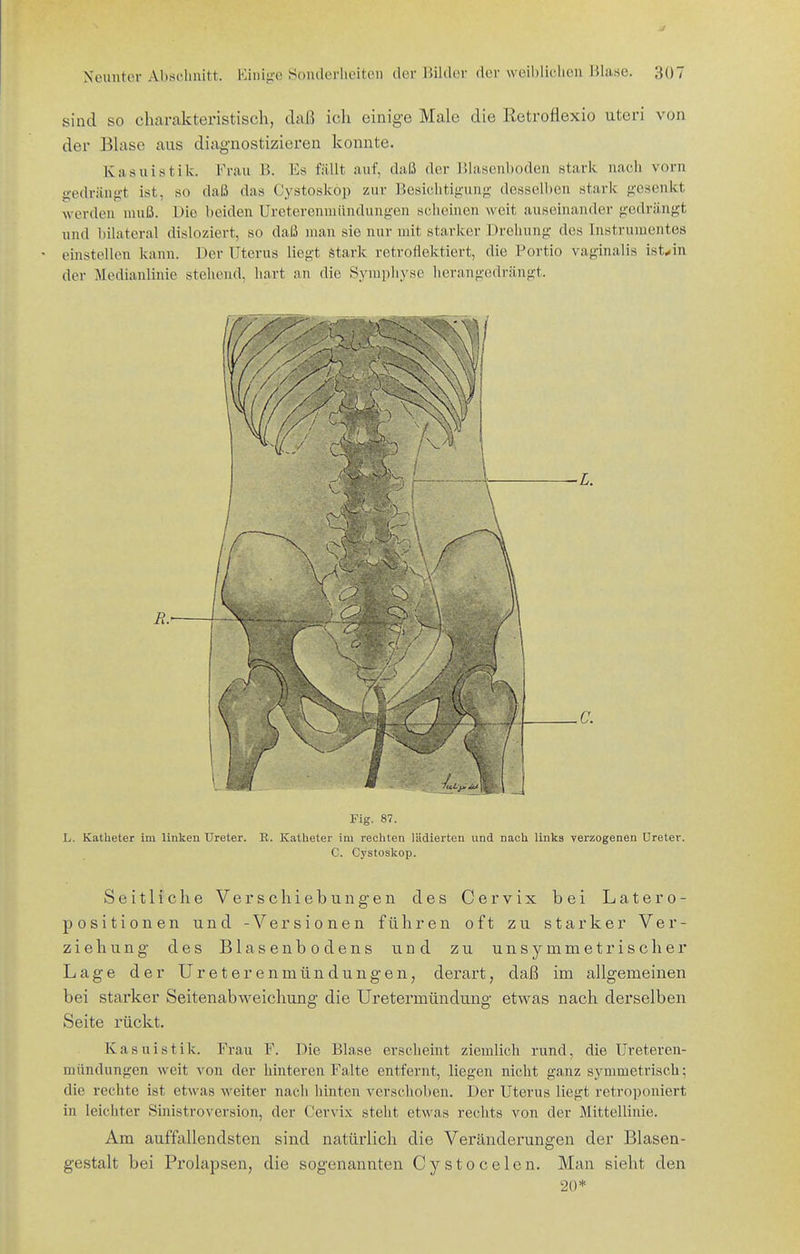 sind so charakteristisch, daß ich einige Male die Retroflexio uteri von der Blase aus diagnostizieren konnte. Kasuistik. Frau B. Es fällt auf, daß der Blascnhoden stark nach vorn «■edrängt ist, so daß das Cystoskop zur Besichtigung desselben stark gesenkt Avcrden muß. Die beiden Ureterenuiündungen scheinen weit auseinander gedrängt und bilateral disloziert, so daß man sie nur mit starker Drehung des Instrumentes einstellen kann. Der Uterus liegt stark retroflektiert, die Portio vaginalis ist^in der Medianlinie stehend, hart an die Symphyse lierangedrängt. E. L. C. Fig. 87. L. Katheter im linken Ureter. K. Katheter im rechten lädierten und nach links verzogenen Ureter. C. Cystoskop. Seitliche Verschiebungen des Cervix bei Latero- positionen und -Versionen führen oft zu starker Ver- ziehung des Blasenbodens und zu unsymmetrischer Lage der Ureterenmündungen, derart, daß im allgemeinen bei starker Seitenabweichung die Uretermündung etwas nach derselben Seite rückt. Kasuistik. Frau F. Die Blase erscheint ziemlich rund, die Ureteren- miindungen weit von der hinteren Falte entfernt, liegen nicht ganz symmetrisch; die rechte ist etwas weiter nach hinten verschoben. Der Uterus liegt rctroponiert in leichter Sinistroversion, der Cervix steht etwas rechts von der Mittellinie. Am auffallendsten sind natürlich die Veränderungen der Blasen- gestalt bei Prolapsen, die sogenannten Cystocelen. Man sieht den 20*