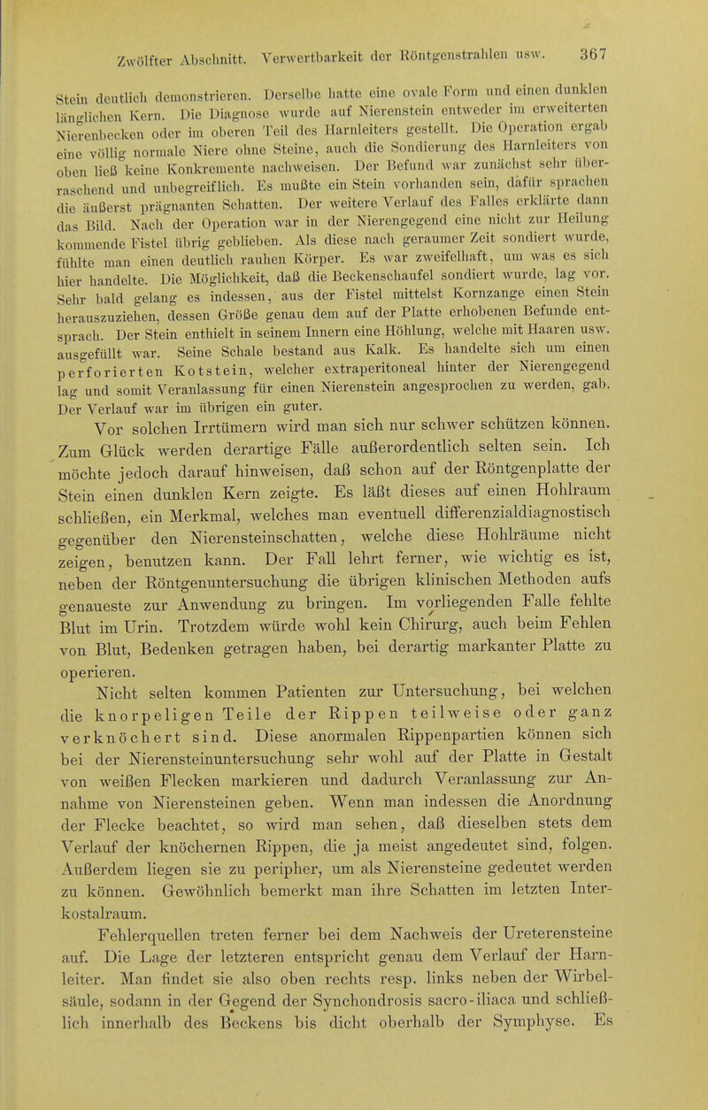 J Zwölfter Abschnitt. Verwertbarkeit der Röntgenstralilen usw. 367 Stein dcntlicli demonstrieren. Derselbe hatte eine ovale Form und einen dunklen IHn-lichen Kern. Die Diagnose wurde auf Nierenstein entweder im erweiterten Nierenbecken oder im oberen Teil des Harnleiters gestellt. Die Operation ergab eine völlig normale Niere ohne Steine, auch die Sondierung des Harnleiters von oben ließ^keine Konkremente nachweisen. Der liefund war zunäclist sehr über- raschend und unbegreiflich. Es mußte ein Stein vorhanden sein, dafür sprachen die äußerst prägnanten Schatten. Der weitere Verlauf des Falles erklärte dann das Bild. Nach der Operation war in der Nierengegend eine nicht zur Heilung kommende Fistel übrig geblieben. Als diese nacli geraumer Zeit sondiert wurde, fühlte man einen deutlich rauhen Körper. Es war zweifelhaft, um was es sich hier handelte. Die Möglichkeit, daß die Beckenschaufel sondiert wurde, lag vor. Sehr bald gelang es indessen, aus der Fistel mittelst Kornzange einen Stein herauszuziehen, dessen Größe genau dem auf der Platte erhobenen Befunde ent- sprach. Der Stein enthielt in seinem Innern eine Höhlung, welche mit Haaren usw. ausgefüllt war. Seine Schale bestand aus Kalk. Es handelte sich um einen perforierten Kotstein, welcher extraperitoneal hinter der Nierengegend lag und somit Veranlassung für einen Nierenstein angesprochen zu werden, gab. Der Verlauf war im übrigen ein guter. Vor solchen Irrtümern wird man sich nur schwer schützen können. Zum Glück werden derartige Fälle außerordentlich selten sein. Ich möchte jedoch darauf hinweisen, daß schon auf der Köntgenplatte der Stein einen dunklen Kern zeigte. Es läßt dieses auf einen Hohlraum schHeßen, ein Merkmal, welches man eventuell differenzialdiagnostisch gegenüber den Nierensteinschatten, welche diese Hohk-äume nicht zeigen, benutzen kann. Der Fall lehrt ferner, wie wichtig es ist, neben der Röntgenuntersuchung die übrigen klinischen Methoden aufs genaueste zur Anwendung zu bringen. Im vorliegenden Falle fehlte Blut im Urin. Trotzdem würde wohl kein Chirurg, auch beim Fehlen von Blut, Bedenken getragen haben, bei derartig markanter Platte zu operieren. Nicht selten kommen Patienten zur Untersuchung, bei welchen die knorpeligen Teile der Rippen teilweise oder ganz verknöchert sind. Diese anormalen Rippenpartien können sich bei der Nierensteinuntersuchung sehr wohl auf der Platte in Gestalt von weißen Flecken markieren und dadurch Veranlassung zur An- nahme von Nierensteinen geben. Wenn man indessen die Anordnung der Flecke beachtet, so wird man sehen, daß dieselben stets dem Verlauf der knöchernen Rippen, die ja meist angedeutet sind, folgen. Außerdem liegen sie zu peripher, um als Nierensteine gedeutet werden zu können. Gewöhnlich bemerkt man ihre Schatten im letzten Inter- kostalraum. Fehlerquellen treten ferner bei dem Nachweis der Ureterensteine auf. Die Lage der letzteren entspricht genau dem Verlauf der Harn- leiter. Man findet sie also oben rechts resp. links neben der Wirbel- säule, sodann in der Gegend der Synchondrosis sacro-iliaca und schließ- lich innerhalb des Beckens bis dicht oberhalb der Symphyse. Es