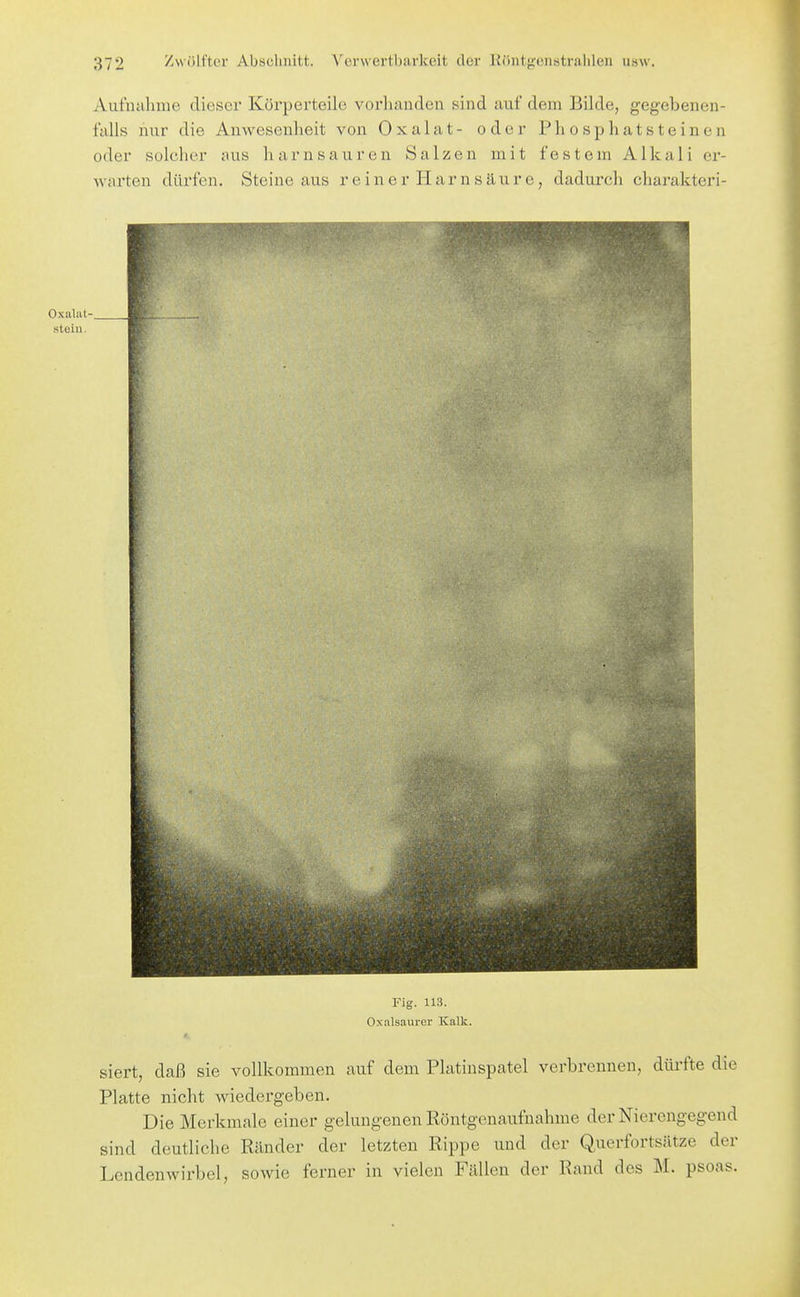 Aufuiihme dieser Körperteile vorhanden sind auf dem Bilde, gegebenen- falls nur die Anwesenheit von Oxalat- oder Phosphatsteinen oder solcher aus harn sauren Salzen mit festem Alkali er- warten dürfen. Steine aus reiner Harnsäure, dadurch charakteri- Oxalat- steiu. Fig. 113. Oxalsaurer Kalk. siert, daß sie vollkommen auf dem Platinspatel verbrennen, düi'fte die Platte nicht wiedergeben. Die Merkmale einer gelungenen Röntgenaufnahme der Nierengegend sind deutliche Ränder der letzten Rippe und der Querfortsätze der Lendenwirbel, sowie ferner in vielen Fällen der Rand des M. psoas.