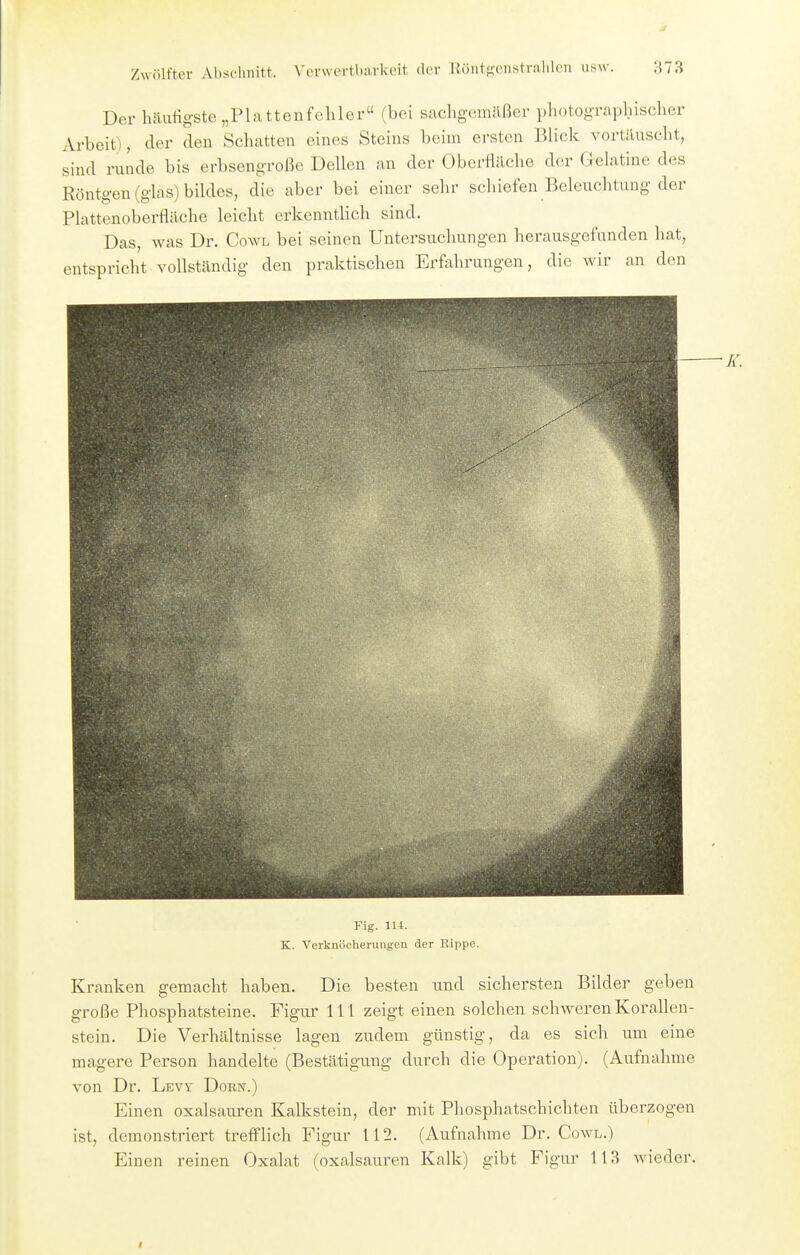 Der häufigste „Pia ttenfelller (bei sachgemäßer photographischer Arbeit), der den Schatten eines Steins beim ersten Blick vortäuscht, sind runde bis erbsengroße Dellen an der Oberfläche der Gelatine des Röntgen (glas) bildes, die aber bei einer sehr schiefen Beleuchtung der Plattenoberfläche leicht erkenntlich sind. Das, was Dr. Cowl bei seinen Untersuchungen herausgefunden hat, entspricht vollständig den praktischen Erfahrungen, die wir an den Fig. 114. K. Verknöcherungen der Rippe. Kranken gemacht haben. Die besten und sichersten Bilder geben große Phosphatsteine. Figur III zeigt einen solchen schweren Korallen- stein. Die Verhältnisse lagen zudem günstig, da es sich um eine magere Person handelte (Bestätigung durch die Operation). (Aufnahme von Dr. Lew Dorn.) Einen Oxalsäuren Kalkstein, der mit Phosphatschichten überzogen ist, demonstriert trefi'lich Figur 112. (Aufnahme Dr. Cowl.) Einen reinen Oxalat (oxalsauren Kalk) gibt Figur 113 wieder.