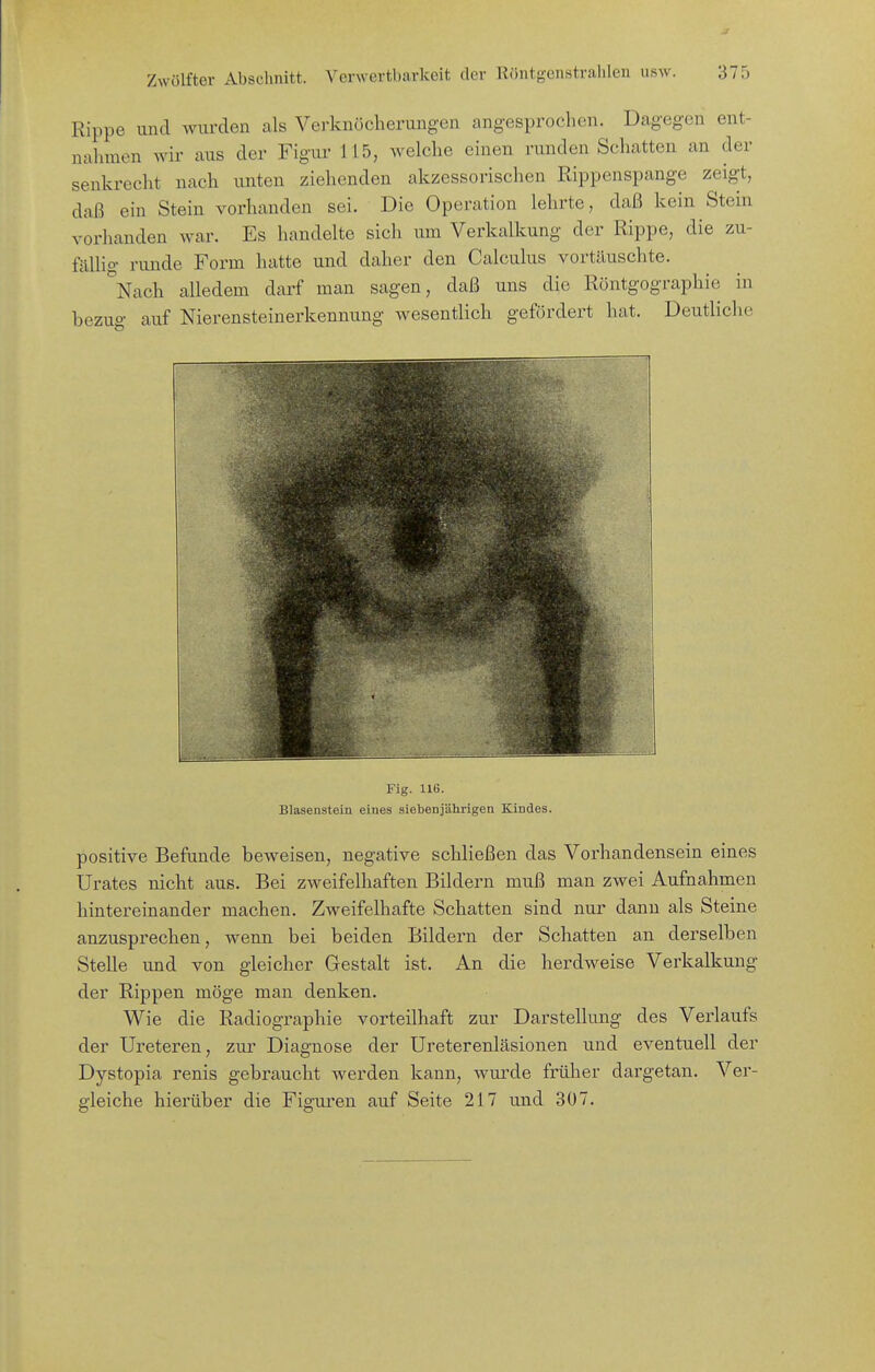 Rippe und wurden cals Vei-knöcherungen angesprochen. Dagegen ent- nahmen wir aus der Figur 115, welche einen runden Schatten an der senkrecht nach unten ziehenden akzessorischen Rippenspange zeigt, daß ein Stein vorhanden sei. Die Operation lehrte, daß kein Stein vorhanden war. Es handelte sich um Verkalkung der Rippe, die zu- fällig runde Form hatte und daher den Calculus vortäuschte. °Nach alledem darf man sagen, daß uns die Röntgographie in bezue- auf Nierensteinerkennung wesentlich gefördert hat. Deutliclic Fig. 116. Blasenstein eines siebenjährigen Kindes. positive Befunde beweisen, negative schließen das Vorhandensein eines Urates nicht aus. Bei zweifelhaften Bildern muß man zwei Aufnahmen hintereinander machen. Zweifelhafte Schatten sind nur dann als Steine anzusprechen, wenn bei beiden Bildern der Schatten an derselben Stelle und von gleicher Gestalt ist. An die herdweise Verkalkung der Rippen möge man denken. Wie die Radiographie vorteilhaft zur Darstellung des Verlaufs der Ureteren, zur Diagnose der Ureterenläsionen und eventuell der Dystopia renis gebraucht werden kann, wurde früher dargetan. Ver- gleiche hierüber die Figuren auf Seite 217 und 307.