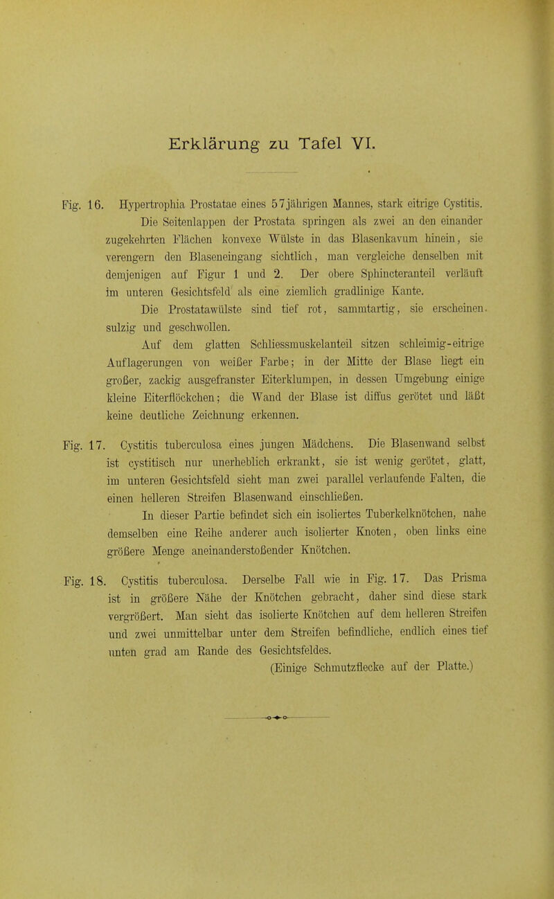 16. Hypertrophia Prostatae eines 5 7 jährigen Mannes, stark eitrige Cystitis. Die Seitenlappen der Prostata springen als zwei an den einander zugekehrten Flächen konvexe Wülste in das Blasenkavum hinein, sie verengern den Blaseneingang sichtlich, man vergleiche denselben mit demjenigen auf Figur 1 und 2. Der obere Sphincterauteil verläuft im unteren Gesichtsfeld als eine ziemlich gradlinige Kante, Die Prostatawülste sind tief rot, sammtartig, sie erscheinen, sulzig und geschwollen. Auf dem glatten Schliessmuskelanteil sitzen schleimig-eitrige Auflagerungen von weißer Farbe; in der Mitte der Blase liegt ein großer, zackig ausgefranster Eiterklumpen, in dessen Umgebung einige kleine Eiterflöckchen; die Wand der Blase ist diffus gerötet und läßt keine deutliche Zeichnung erkennen. 17. Cystitis tuberculosa eines jungen Mädchens. Die Blasenwand selbst ist cystitisch nur unerheblich erkrankt, sie ist wenig gerötet, glatt, im unteren Gesichtsfeld sieht man zwei parallel verlaufende Falten, die einen helleren Streifen Blasenwand einschließen. In dieser Partie befindet sich ein isoliertes Tuberkelknötchen, nahe demselben eine Reihe anderer auch isolierter Knoten, oben links eine größere Menge aneinanderstoßender Knötchen. 18. Cystitis tuberculosa. Derselbe Fall wie in Fig. 17. Das Prisma ist in größere Nähe der Knötchen gebracht, daher sind diese stark vergrößert. Man sieht das isolierte Knötchen auf dem helleren Streifen und zwei unmittelbar unter dem Streifen befindliche, endlich eines tief unten grad am Rande des Gesichtsfeldes. (Einige Schmutzflecke auf der Platte.)