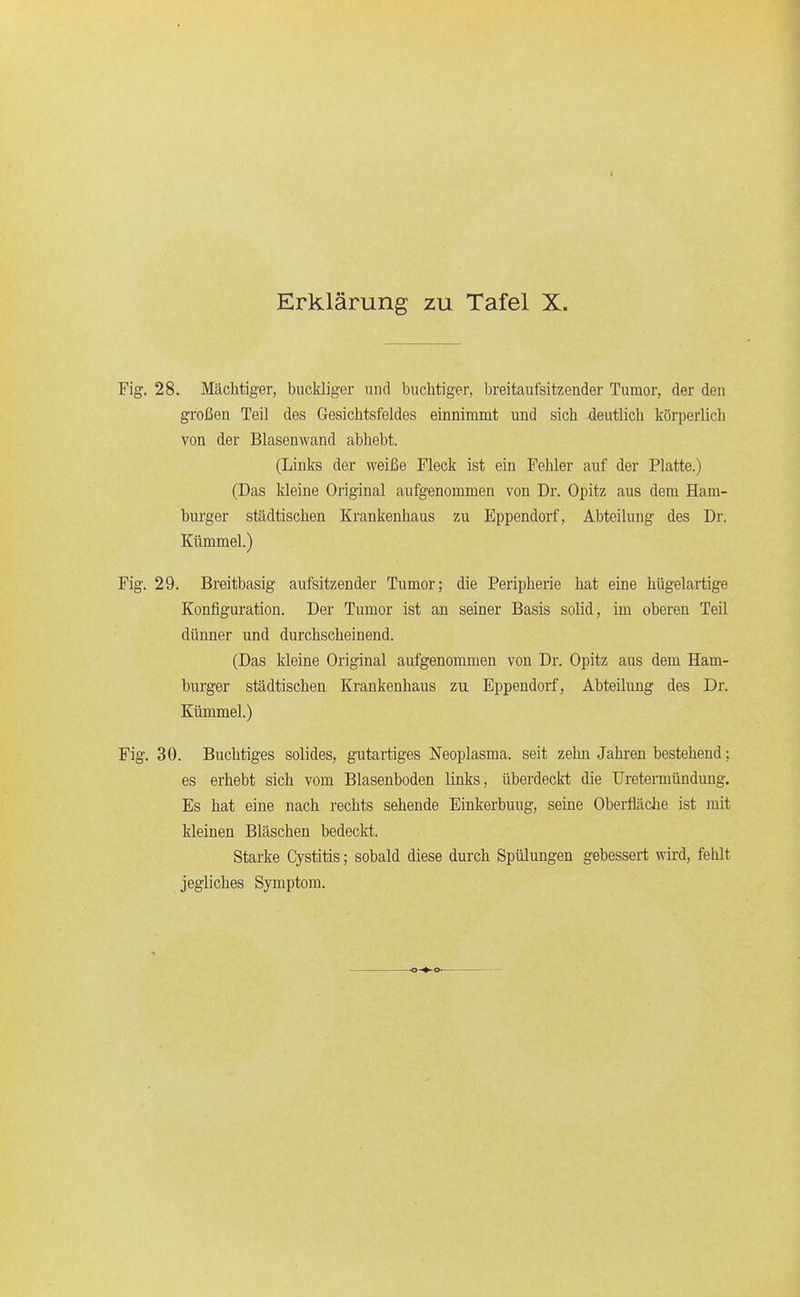 Fig. 28. Mächtiger, buckliger nnd buchtiger, breitaufsitzender Tumor, der den großen Teil des Gesichtsfeldes einnimmt und sich deutlich körperlich von der Blasenwand abhebt. (Links der weiße Fleck ist ein Fehler auf der Platte.) (Das kleine Original aufgenommen von Dr. Opitz aus dem Ham- burger städtischen Krankenhaus zu Eppendorf, Abteilung des Dr. Kümmel.) Fig. 29. Breitbasig aufsitzender Tumor; die Peripherie hat eine hügelartige Konfiguration. Der Tumor ist an seiner Basis solid, im oberen Teil dünner und durchscheinend. (Das kleine Original aufgenommen von Dr. Opitz aus dem Ham- burger städtischen Krankenhaus zu Eppendorf, Abteilung des Dr. Kümmel.) Fig. 30. Buchtiges solides, gutartiges Neoplasma, seit zehn Jahren bestehend; es erhebt sich vom Blasenboden links, überdeckt die Uretermündung. Es hat eine nach rechts sehende Einkerbung, seine Oberfläche ist mit kleinen Bläschen bedeckt. Starke Cystitis; sobald diese durch Spülungen gebessert wird, fehlt jegliches Symptom.