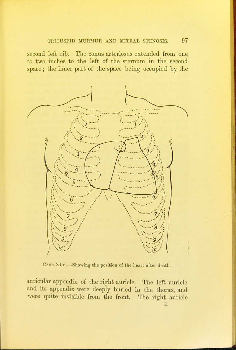 second left rib. The conus arteriosus extended from one to two inches to the left of the sternum in the second space; the inner part of the space being occupied by the Case XIV.—Showing the position of the heart after death. auricular appendix of the right auricle. The left auricle and its appendix were deeply buried iu the thorax, and were quite invisible from the front. The right auricle H