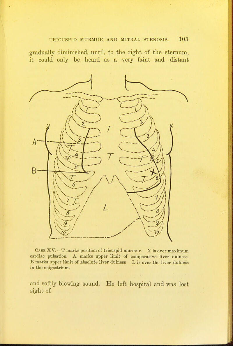 gradually diminished, until, to the right of the sternum, it could only be heard as a very faint and distant Case XV.—T marks position of tricuspid murmur. X is over maximum cardiac pulsation. A marks upper limit of comparative liver dulness. B marks upper limit of absolute liver dulness L is over the liver dulness in the epigastrium. and softly blowing sound. He left hospital and was lost sight of.