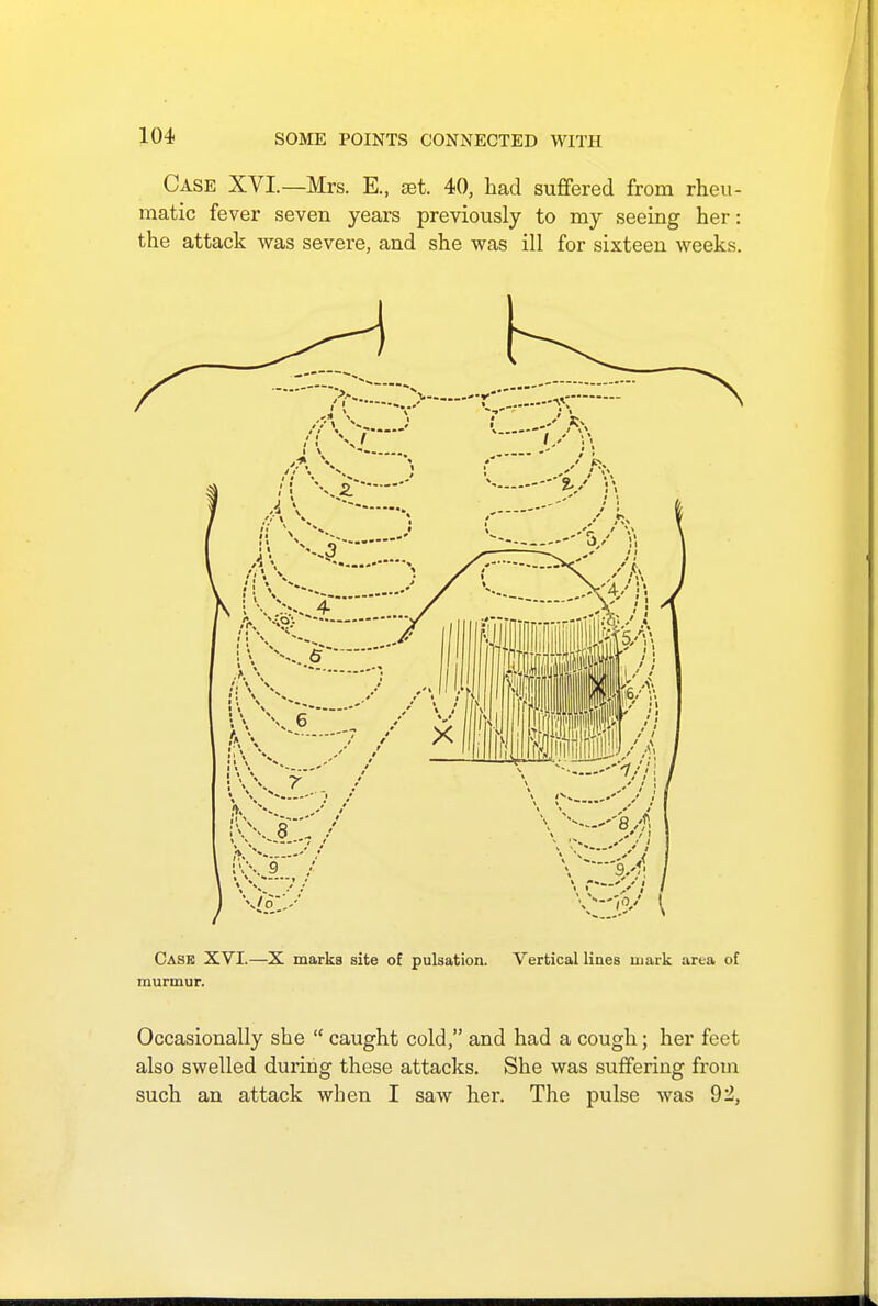 Case XVI.—Mrs. E., jet. 40, had suffered from rheu- matic fever seven years previously to my seeing her: the attack was severe, and she was ill for sixteen weeks. Case XVI.—X marks site of pulsation. Vertical lines mark area of murmur. Occasionally she  caught cold, and had a cough; her feet also swelled during these attacks. She was suffering from such an attack when I saw her. The pulse was 92,