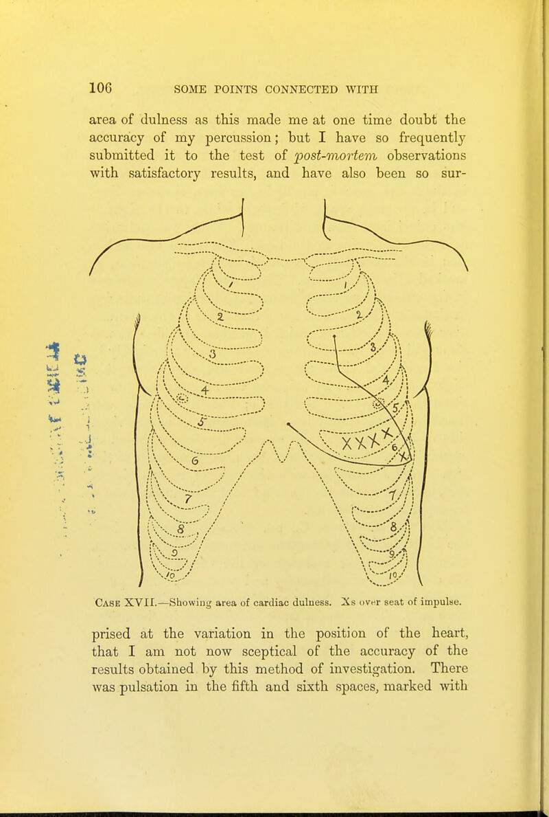 area of dulness as this made me at one time doubt the accuracy of my percussion; but I have so frequently submitted it to the test of 'post-mortem observations with satisfactory results, and have also been so sur- Case XVII.—Showing area of cardiac dulness. Xs over seat of impulse. prised at the variation in the position of the heart, that I am not now sceptical of the accuracy of the results obtained by this method of investigation. There was pulsation in the fifth and sixth spaces, marked with