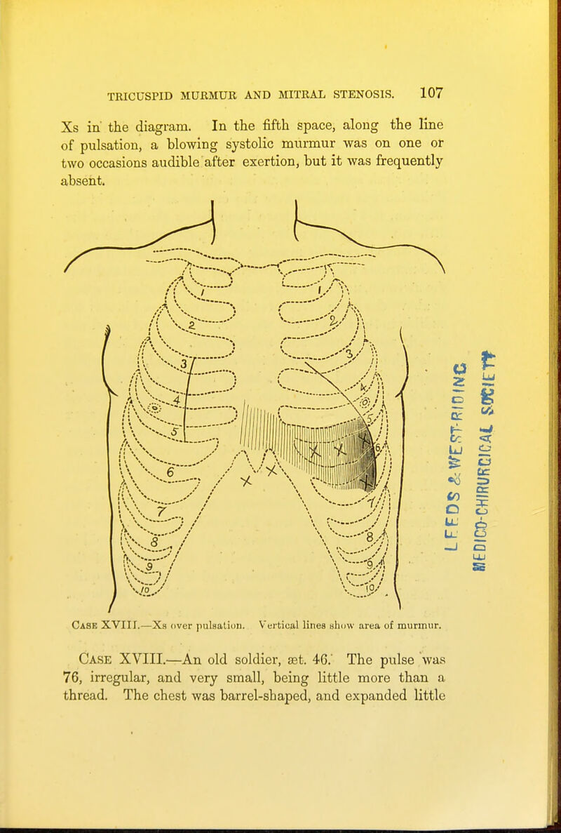 Xs in' the diagram. In the fifth space, along the line of pulsation, a blowing systolic murmur was on one or two occasions audible after exertion, but it was frequently absent. Case XVIII.—Xs over pulsation. Vertical lines show area of murmur. Case XVIII.—An old soldier, set. 46.' The pulse was 76, irregular, and very small, being little more than a thread. The chest was barrel-sbaped, and expanded little