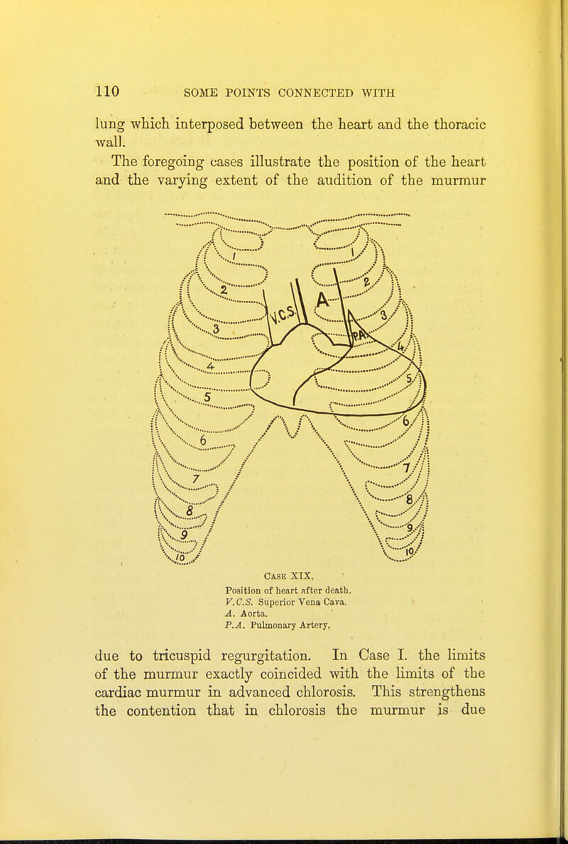 lung which interposed between the heart and the thoracic wall. > The foregoirjg cases illustrate the position of the heart and the varying extent of the audition of the murmur CASE XIX. Position of heart after death. V.C.S. Superior Vena Cava. A. Aorta. P. A. Pulmonary Artery. due to tricuspid regurgitation. In Case I. the limits of the murmur exactly coincided with the limits of the cardiac murmur in advanced chlorosis. This strengthens the contention that in chlorosis the murmur is due