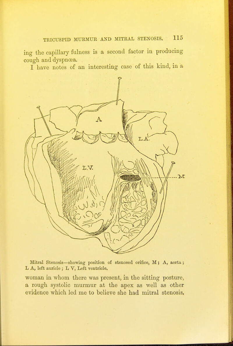 ing the capillary fulness is a second factor in producing cough and dyspnoea. I have notes of an interesting case of this kind, in a Mitral Stenosis—showing position of stenosed orifice, M 5 A, aorta; L A, left auricle ; L V, Left ventricle. woman in whom there was present, in the sitting posture, a rough systolic murmur at the apex as well as other evidence which led me to helieve she had mitral stenosis.