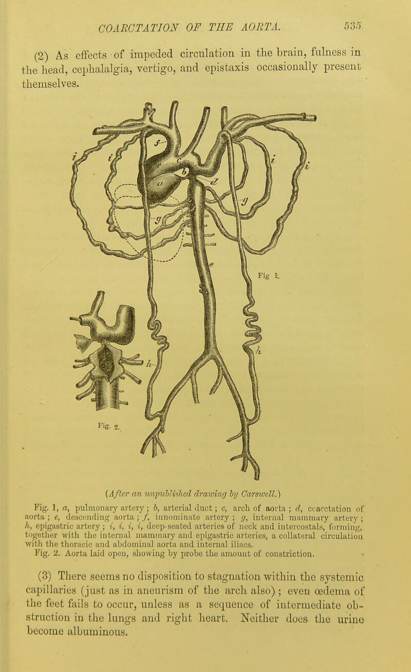 (2) As effects of impeded circulation in the brain, fulness in the head, cephalalgia, vertigo, and epistaxis occasionally present themselves. (After an unpublished drawing by Carsivell.) Fig. 1, a, pulmonary artery; b, arterial duct; c, arcli of aorta; d, coarctation of aorta; e, descending aorta,;/, innominate artery; g, internal mammary artery; h, epigastric artery ; i, i, i, i, deep-seated arteries of neck and intercostals, forming, together with the internal mammary and epigastric arteries, a collateral circulation with the thoracic and abdominal aorta and internal iliacs. Fig. 2. Aorta laid open, showing by probe the amount of constriction. (3) There seems no disposition to stagnation within the systemic capillaries (just as in aneurism of the arch also) ; even oedema of the feet fails to occur, unless as a sequence of intermediate ob- struction in the lungs and right heart. Neither docs the urine become albuminous.