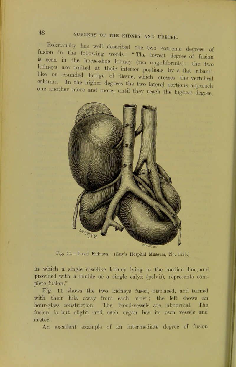 SURGERY OF THE KIDxVEY AND URETER. Rokitansky has well described the two extreme degrees of fusion in the followmg words:  The lowest degree of fusion IS seen m the horse-shoe kidney (ren unguliforniis); the two kidneys are nnited at their inferior portions by a flat riband- Iike or rounded bridge of tissue, which crosses the A-ertebral column. In the higher degrees the two lateral portions approach one another more and more, until thev reach the highest degree Fig. 11.—Fused Kidneys. ; (Guy's Hospital Museum, No. 1583.) in which a single disc-like kidney lymg in the median line, and provided with a double or a single calyx (pelvis), i-epresents com- plete fusion. Fig. 11 shows the two kidneys fused, displaced, and tui-ned with their hila away from each other; the left shows an hour-glass constriction. The blood-vessels are abnormal. Tlie fusion is but slight, and each organ has its own vessels and ureter. An excellent example of an intermediate degree of fusion