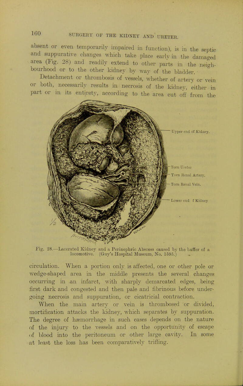 absent or even temporarily impaired in function), is in the septic and suppurative changes which take place early in the damaged area (Fig. 28) and readily extend to other parts in the neigh- bourhood or to the other kidney by way of the bladder. Detachment or thrombosis of vessels, whether of iirter.y or vein or both, necessarily results in necrosis of the kidney, either in part or in its entirety, according to the area cut off from the Upiier end of Kidney. Torn Uieter Torn Renal Artery. Torn Renal Vein. Lower end f Kidney Fig. 28.—Lacerated Kidney and a Perinephric Abscess caused by the buffer of a locomotive. (Guy's Hospital Museum, No. 1595.) circulation. When a portion only is affected, one or other pole or Avedge-shaped area in the middle presents the several changes occurring in an mfarct, with sharply demarcated edges, being first dark and congested and then j)ale and fibrinous before under- going necrosis and suppuration, or cicatricial contraction. When the main artery or vein is thrombosed or divided, mortification attacks the kidney, which separates by suppuration. The degree of haemorrhage in such cases depends on the nature of the injury to the vessels and on the opportunit}- of escape of blood into the peritoneum or other large cavity. In some at least the loss has been comparatively trifling.