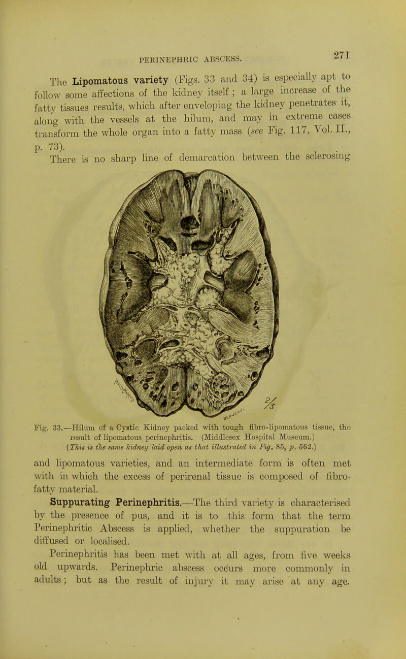 PERINEPHRIC ABSCESS. The Lipomatous variety (Figs. 33 and 34) is especially apt to follow some affections of the kidney itself ; a large increase of the fatty tissues results, which after enveloping the kidney penetrates- it, along with the vessels at the hilum, and may in extreme cases transform the whole organ into a fatty mass (see Fig. 117, Vol. II., p. 73). There is no sharp line of demarcation between the sclerosmg Fig. 33.—Hilum of a Cystic Kidney packed with tougli fibro-liijomatous tissue, the result of lipomatous perinephritis. (Middlesex Hospital Museum.) (This is t)ie same kidnei/ laid open as that illustrated in Fig. 85, p. 662.) and lipomatous varieties, and an intermediate form is often met with in which the excess of perirenal tissue is composed of fibro- fatty material. Suppurating Perinephritis.—The third variety is characterised by the presence of pus, and it is to this form that the term Perinephritic Abscess is applied, whether the suppuration be diffused or localised. Perinephritis has been met with at all ages, from five weeks old upwards. Perinephric abscess occurs more commonly in adults; but as the result of injury it may arise at any age.