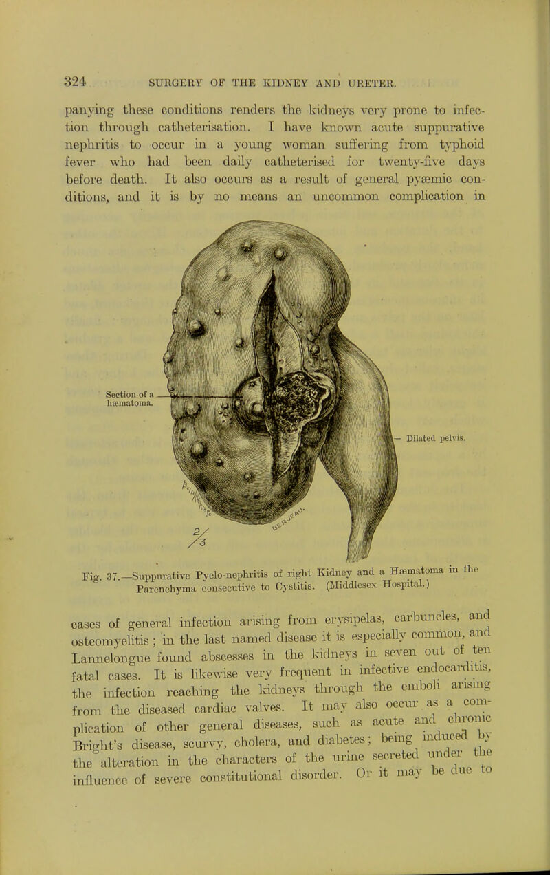 panying these conditions renders the kidneys very prone to infec- tion through catheterisation. I have known acute suppurative nephritis to occur in a young woman suffei'ing from typhoid fever who had been daily catheterised for twenty-five days before death. It also occurs as a result of general pyoemic con- ditions, and it is by no means an uncommon complication in Section of a lisematoraa. Dilated iielvis. Fio-. 37.-Suppm-ative Pyelo-neplu-itis of right Kidney and a Hsematoma in the Parenchyma consecutive to Cystitis. (Middlesex Hospital.) cases of general infection arising from erysipelas, carbuncles, and osteomyelitis ; m the last named disease it is especially common, and Lannelongue found abscesses in the kidneys m seven out of ten fatal cases. It is likewise very frequent in infective endocarditis, the infection reaching the kidneys through the emboli arising from the diseased cardiac valves. It may also occur as a com- plication of other general diseases, such as acute and chrome Bricrht's disease, scurvy, cholera, and diabetes; being mduced b> the°alteration in the characters of the urine secreted under the influence of severe constitutional disorder. Or it may be due to