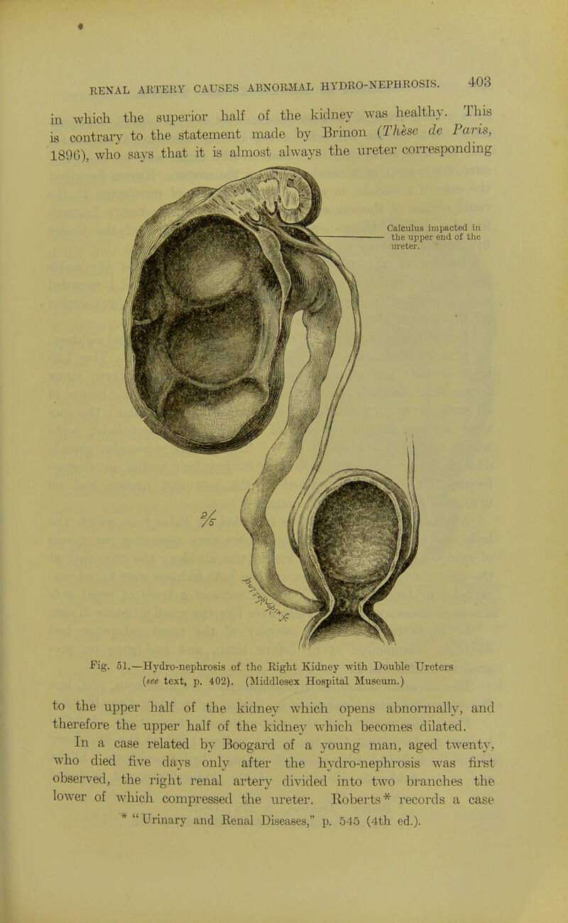 « RENAL ARTERY CAUSES ABNORMAL HYDRO-NEPHROSIS. 4Ud in which the superior half of the kidney was healthy. This is contrary to the statement made by Brinon (These de Paris, 1896), who says that it is almost always the ureter corresponding Fig. 51.—Hydro-nephrosis of the Right Kidney with Douhle TJreters {see text, p. 402). (Middlesex Hospital Museum.) to the upper half of the kidney which opens abnormally, and therefore the upper half of the kidnev which becomes dilated. In a case related by Boogard of a young man, aged twent}-, who died five days only after the hydro-nephrosis was first observed, the right renal artery divided into two branches the lower of Avhich compressed the ureter. Eoberts* records a case *  Urinary and Renal Diseases, p. 545 (4th ed.).