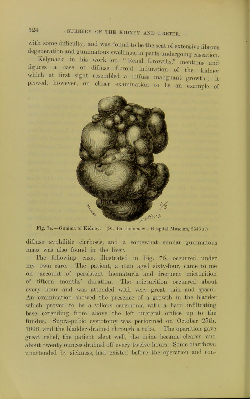 With some difficulty, and was found to he the seat of extensive filjrous degeneration and gummatous swellings, in parts undergoing caseation Kelynack in his work on -Renal Growths, mentions and figures a case of diffuse fibroid induration of the kidney which at first sight resembled a diffuse malignant growth; it proved, however, on closer examination to be an examnle nf Fig. 74.—Gumma of Kidney. (St. Bartholomew's Hospital Museum, 2343 a.) diff'use syphilitic cirrhosis, and a somewhat similar gummatous mass was also found in the liver. The following case, illustrated in Fig. 75, occm-red under my own care. The patient, a man aged sixty-four, came to me on account of persistent ha^maturia and frequent micturition of fifteen months' duration. The micturition occurred about every hour and was attended with veiy great pain and spasm. An examination showed the pi'esence of a growth in the bladder which proved to be a villous carcmoma with a hai'd mfiltrating base extending fi'om above the left ureteral orifice up to the fundus. Supra-pubic cystotomy was perfoi'med on October 25th, 1898, and the bladder drained through a tube. The operation gave gi-eat I'elief, the patient slept well, the urine became clearei-, and alx)ut twenty ounces drained off eveiy twelve houi-s. Some diarrhcea, unattended 1)y sickness, had existed before the operation and con-