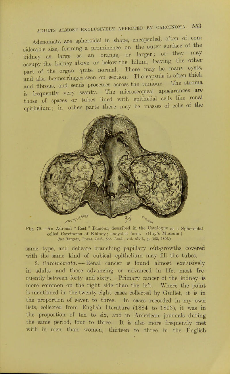 Adenomata are spheroidal in shape, encapsuled, often of con- siderable size, forming a prominence on the outer surface of the kidney as large as an orange, or larger; or they may occupy the kidney above or below the hilum, leavmg the other part of the organ quite normal. There may be many cysts, and also htemorrhages seen on section. The capsule is often thick and fibrous, and sends processes across the tumour. The stroma is frequently very scanty. The microscopical appearances are those of spaces or tubes lined with epithelial cells hke renal epithelium; in other parts there may be masses of cells of the Fig. 79.—Au Adrenal Rest Tumour, described in the Catalogue as a Spheroidal- ceUed Carcinoma of Kidney; encysted form. (Guy's Museum.) (Sec Targefct, Trans. Path. Soc. Loml., vol. xlvii., p. 123, 1896.) same type, and delicate branching papillary oiit-growths covered with the same kind of cubical epithelium may fill the tubes. 2. Carcinomata. — Renal cancer is found almost exclusively in adults and those advancing oi advanced in life, most fre- quently between forty and sixty. Primary cancer of the kidney is more common on the right side than the left. Where the point is mentioned in the twenty-eight cases collected by Guillet, it is in the proportion of seven to three. In cases recorded in my own lists, collected from English literature (1884 to 1893), it was in the proportion of ten to six, and in American journals during the same period, four to three. It is also more frequently met with in men than women, thirteen to three in the English